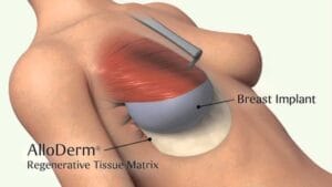 infographic of a breast implant