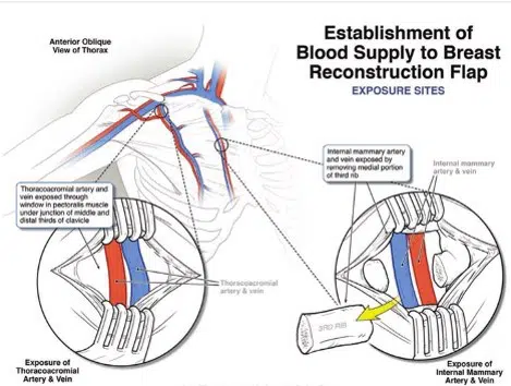 infographic of blood supply to the breast reconstruction flap