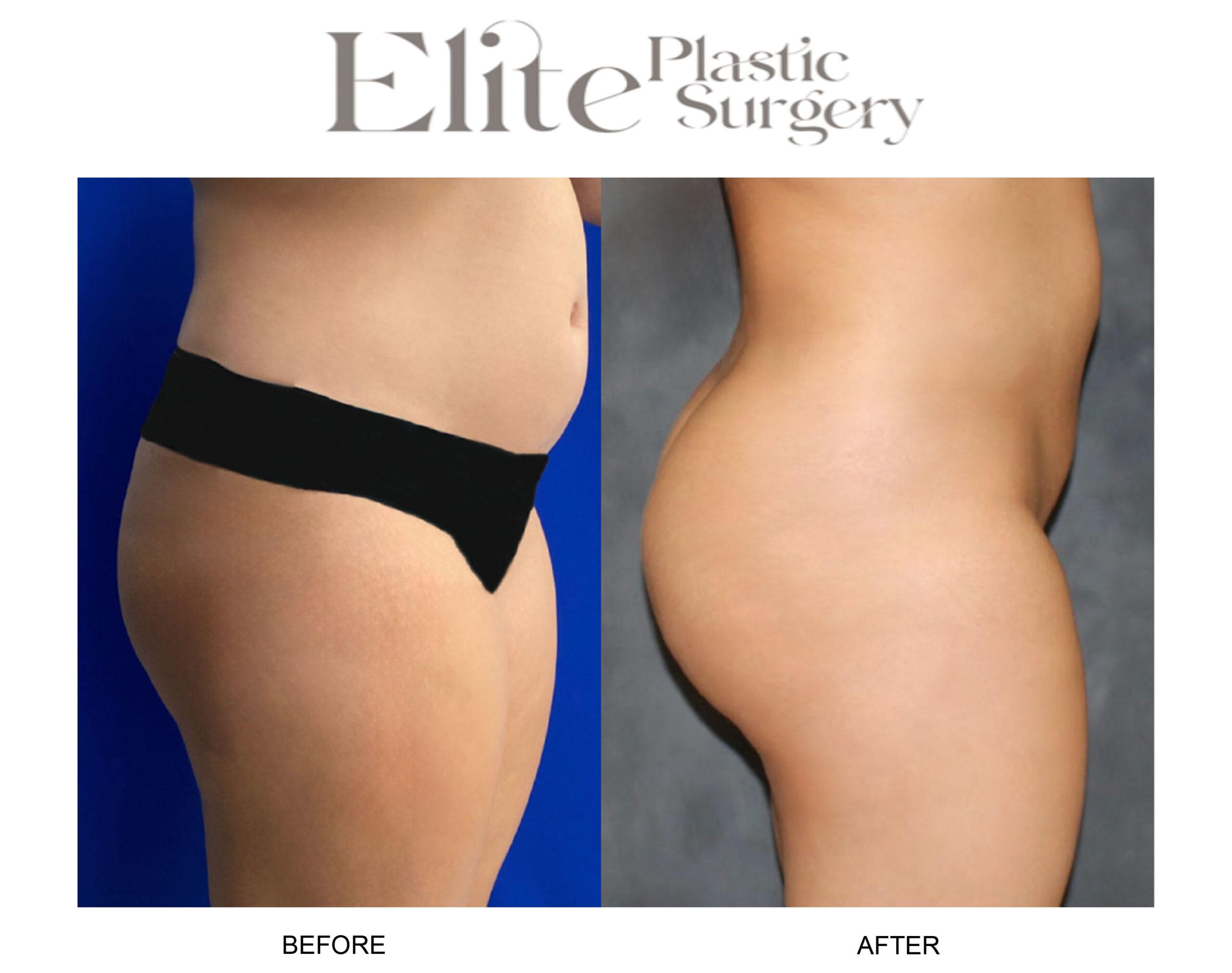 Brazilian Butt Lift (BBL) Before & After Gallery - Patient 179607 - Image 1