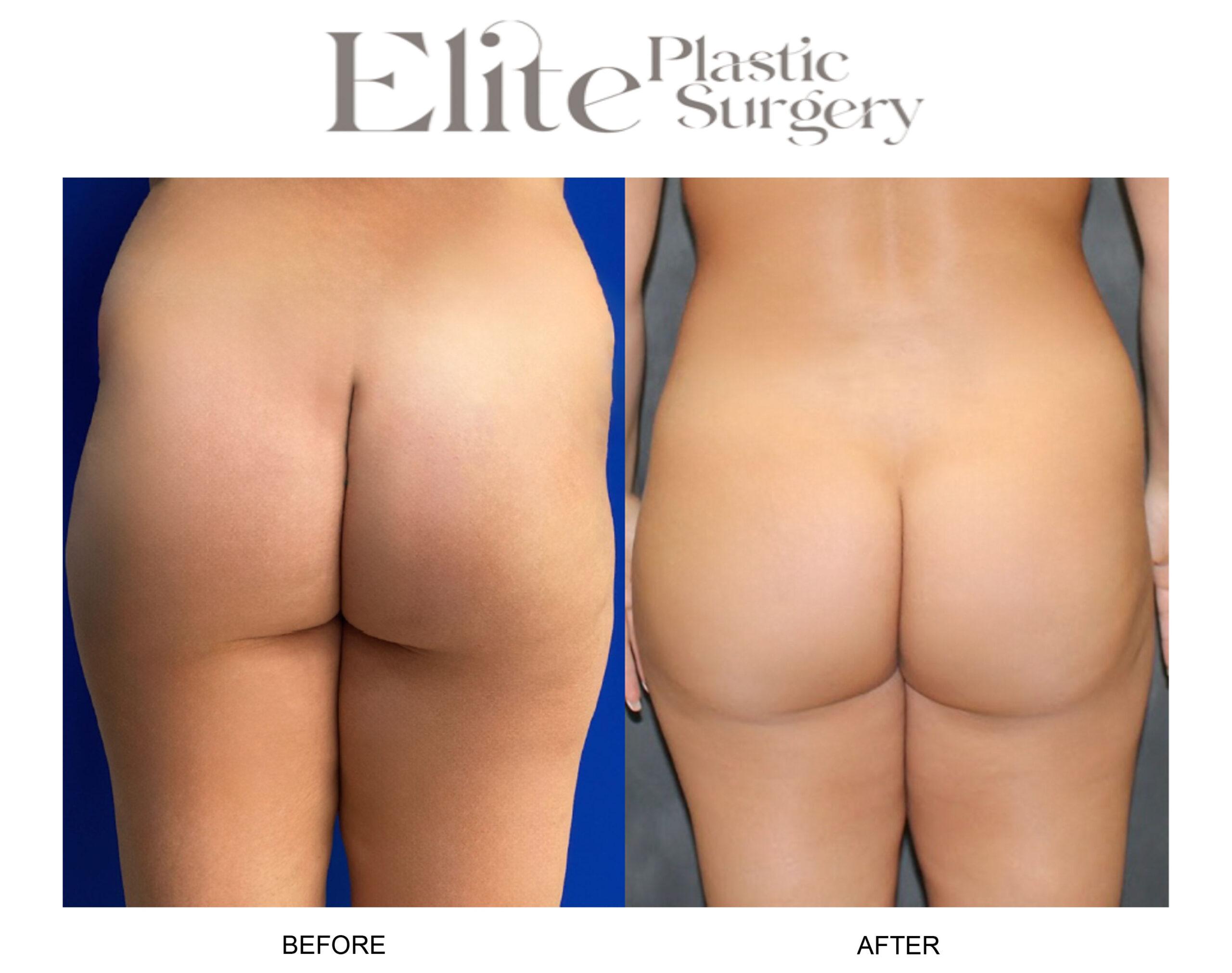 Brazilian Butt Lift (BBL) Before & After Gallery - Patient 179607 - Image 2