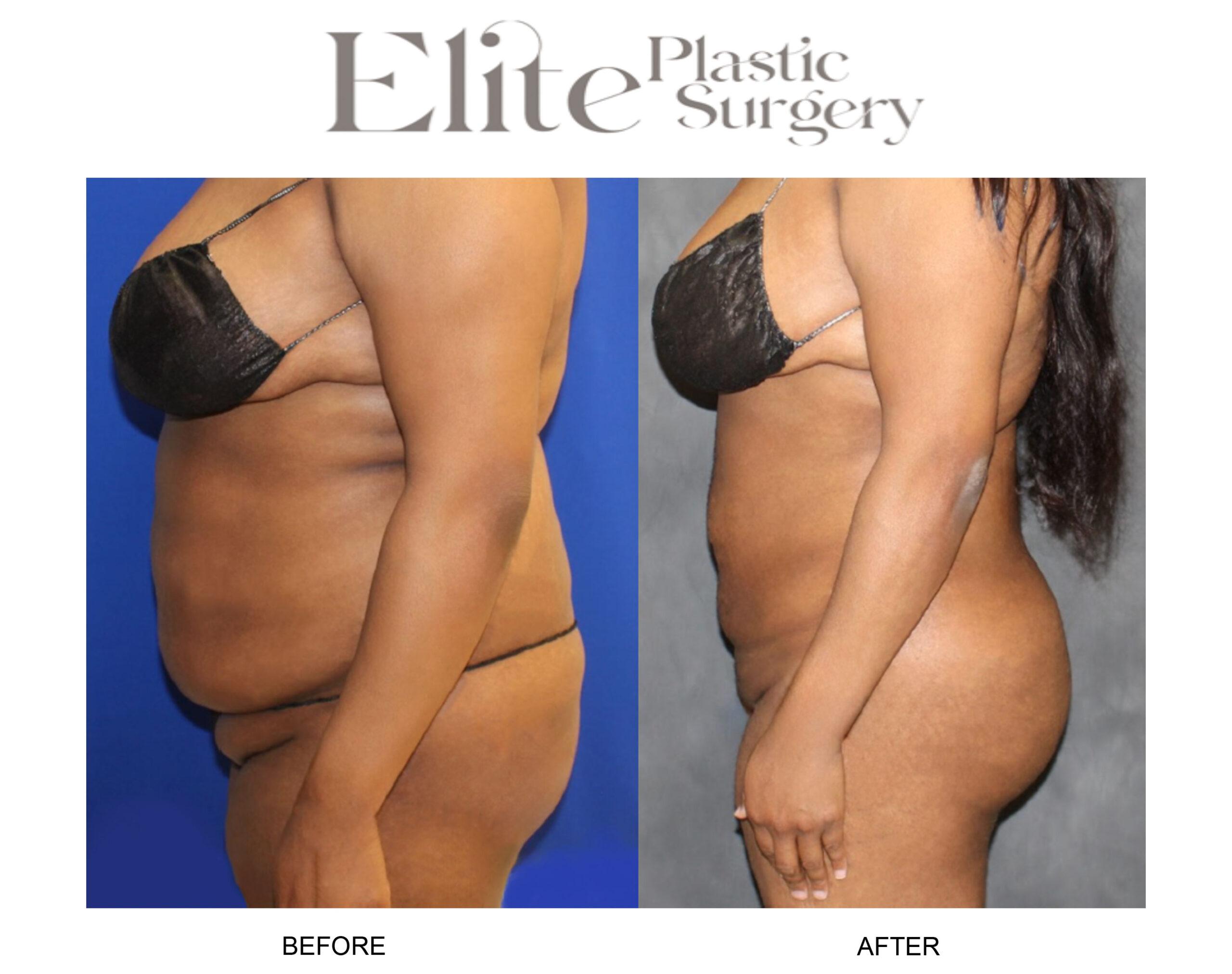 Brazilian Butt Lift (BBL) Before & After Gallery - Patient 327545 - Image 1