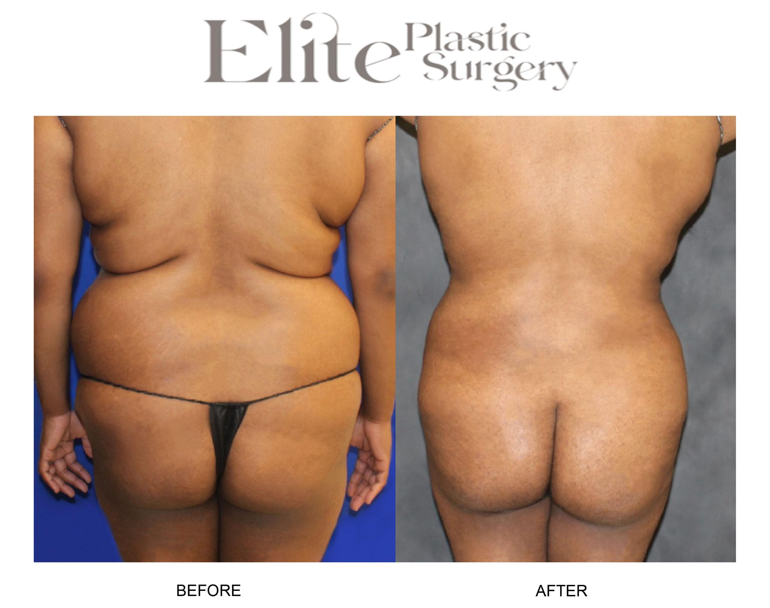 Brazilian Butt Lift (BBL) Before & After Gallery - Patient 327545 - Image 2
