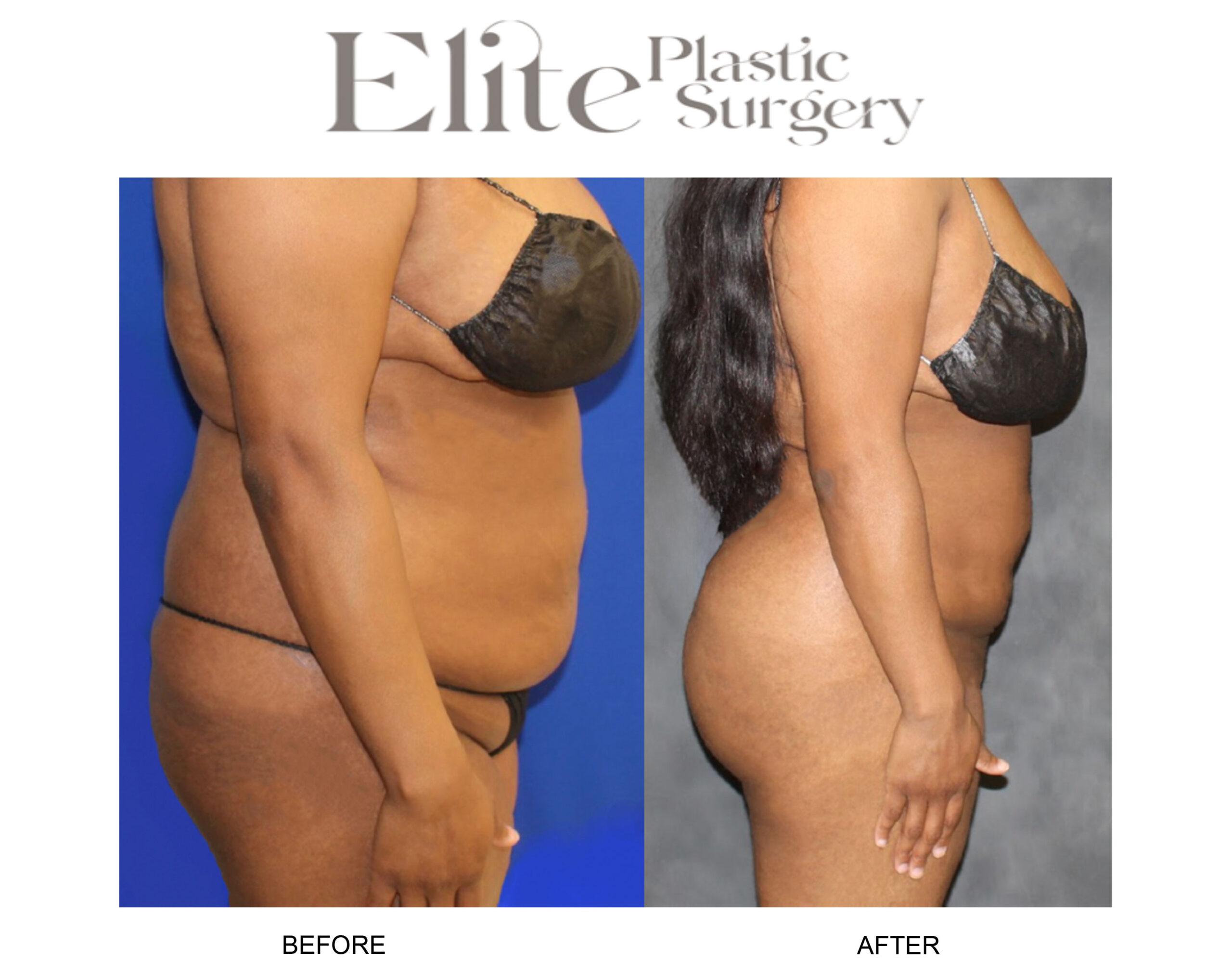 Brazilian Butt Lift (BBL) Before & After Gallery - Patient 327545 - Image 3