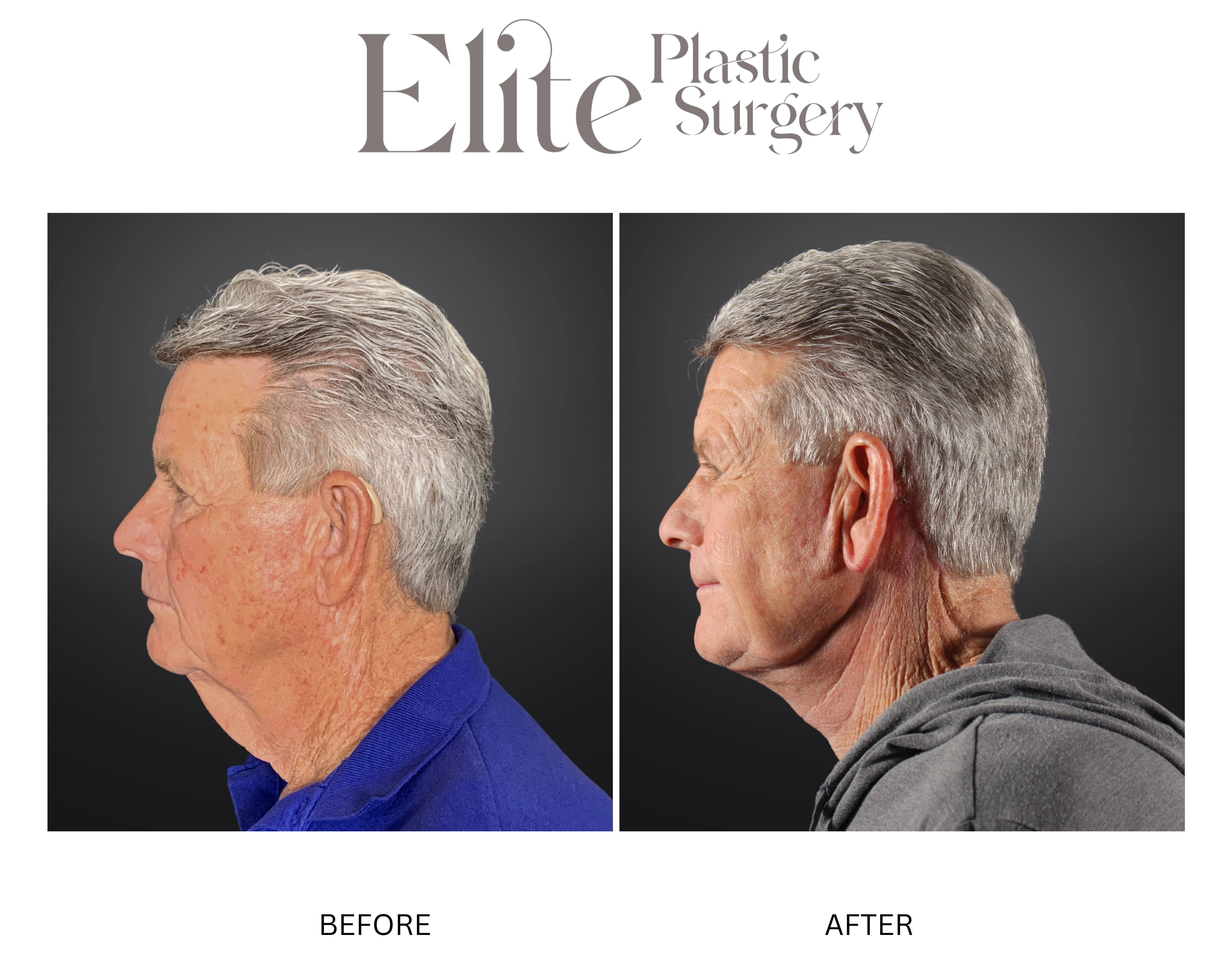 Neck Lift Before & After Gallery - Patient 290062 - Image 1