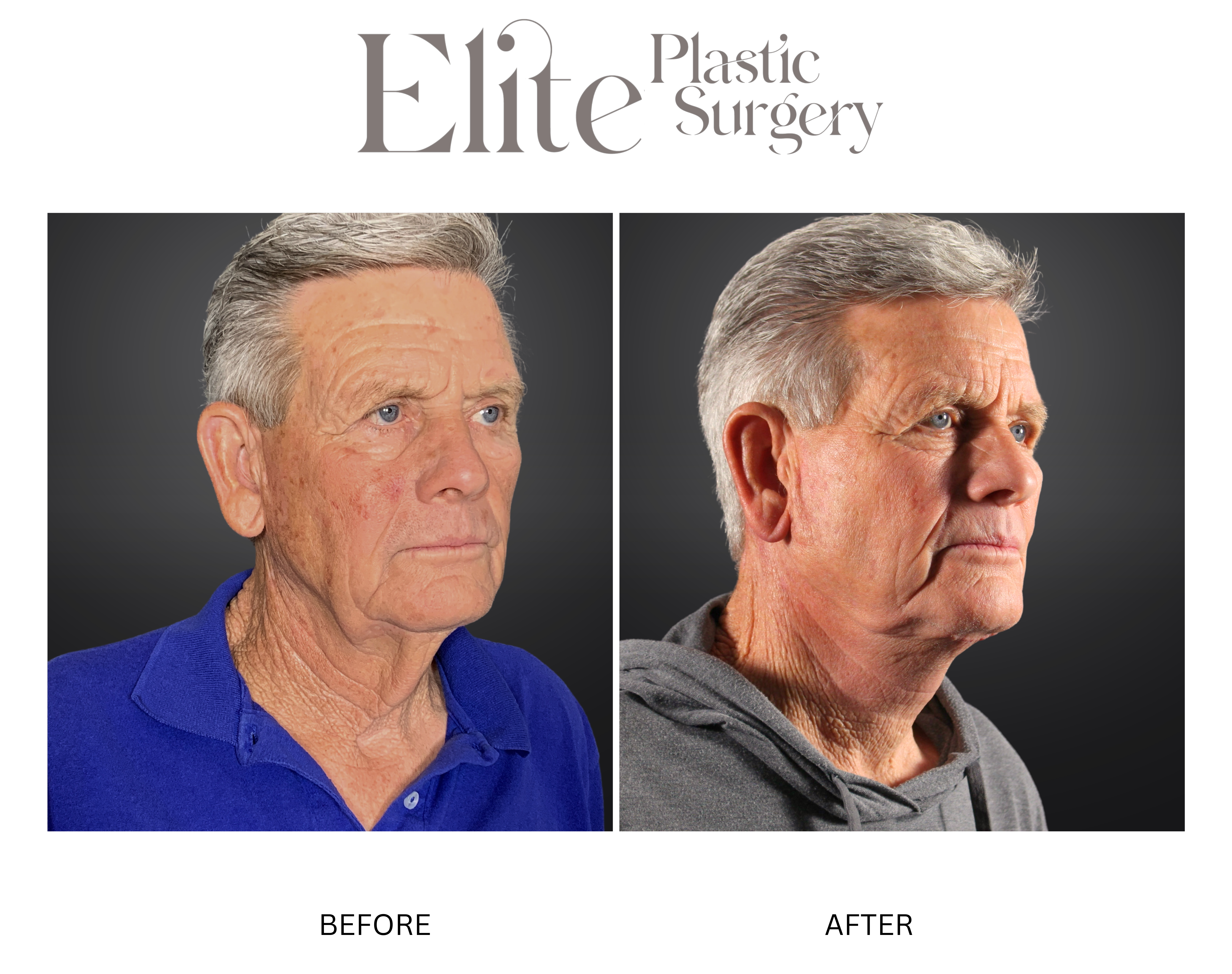 Neck Lift Before & After Gallery - Patient 290062 - Image 2