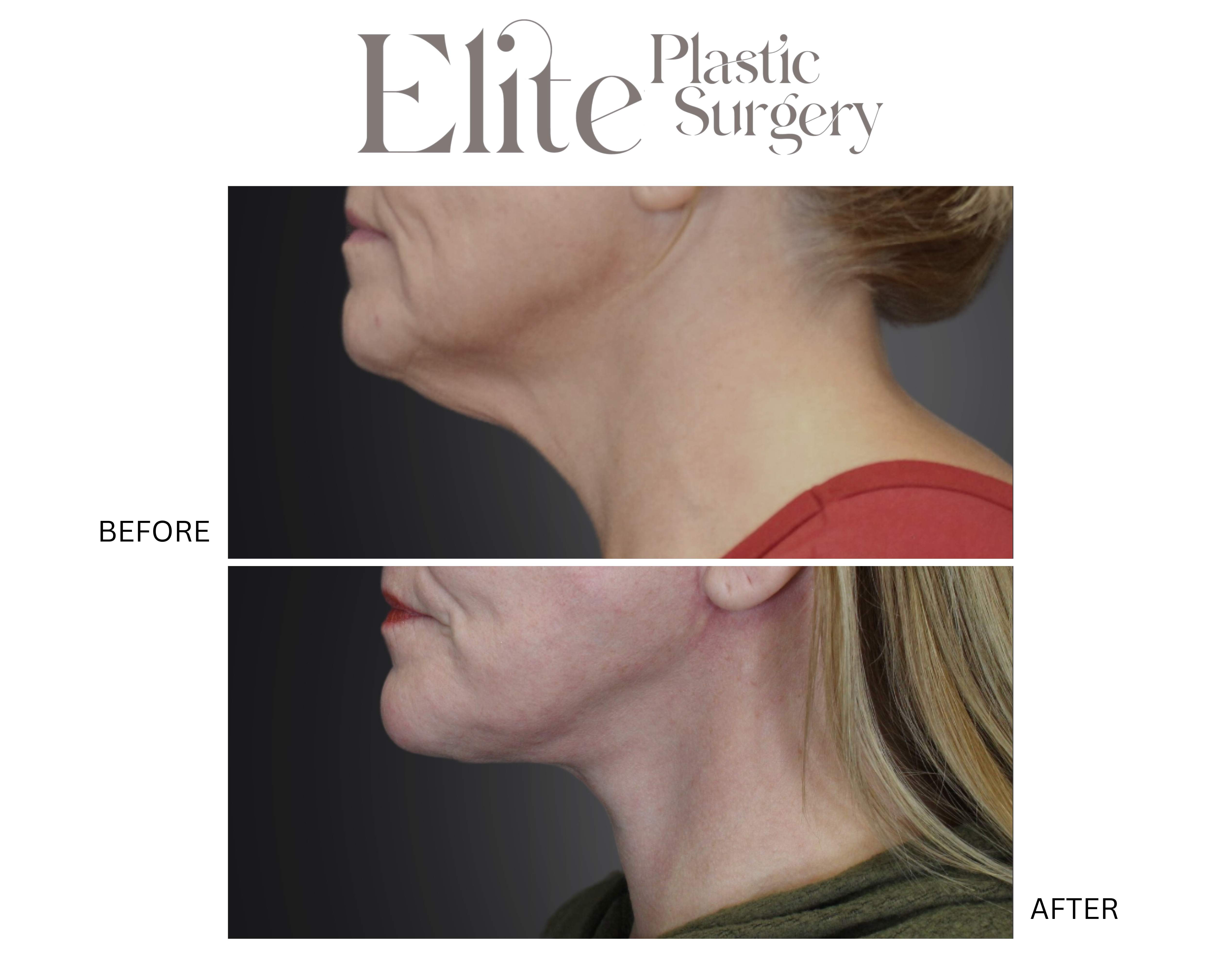 Neck Lift Before & After Gallery - Patient 413426 - Image 1