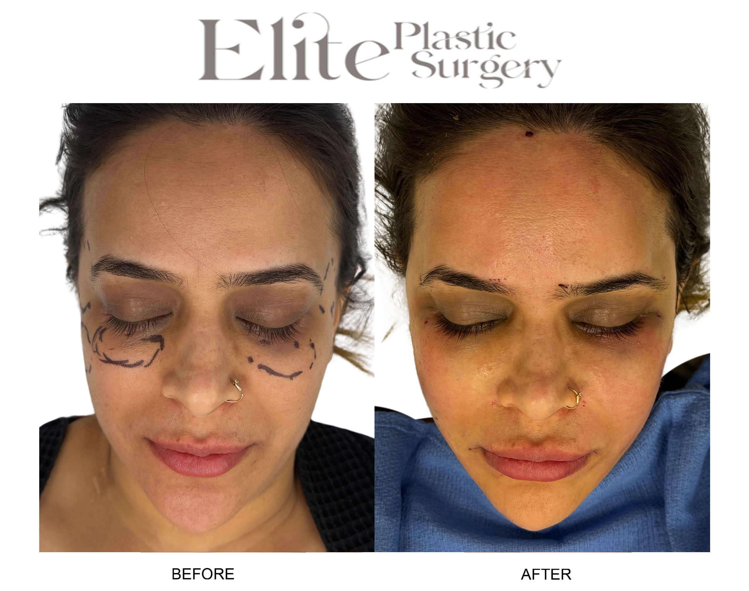 Facial Fat Transfer Before & After Gallery - Patient 168250 - Image 1