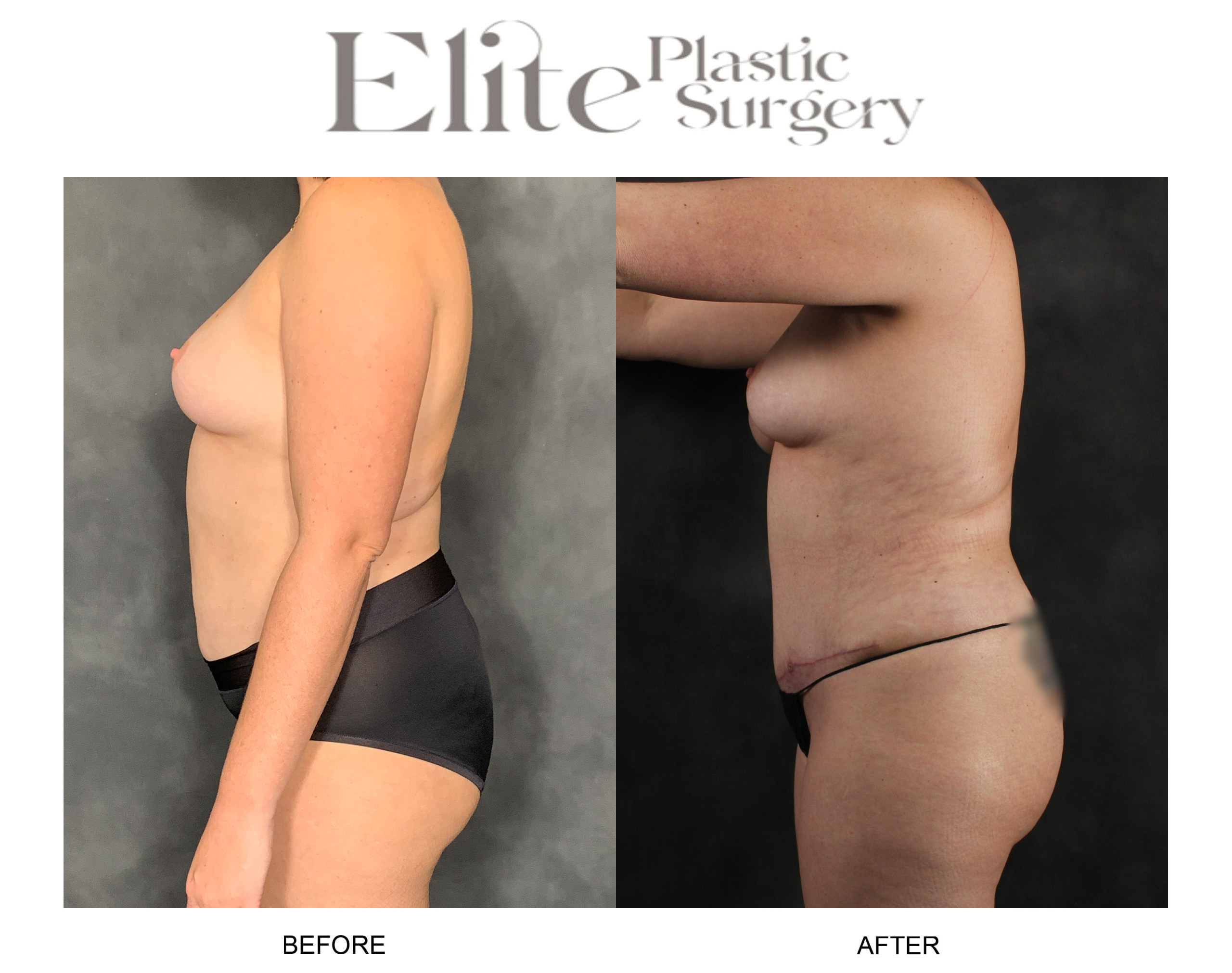 Liposuction Before & After Gallery - Patient 419962 - Image 3