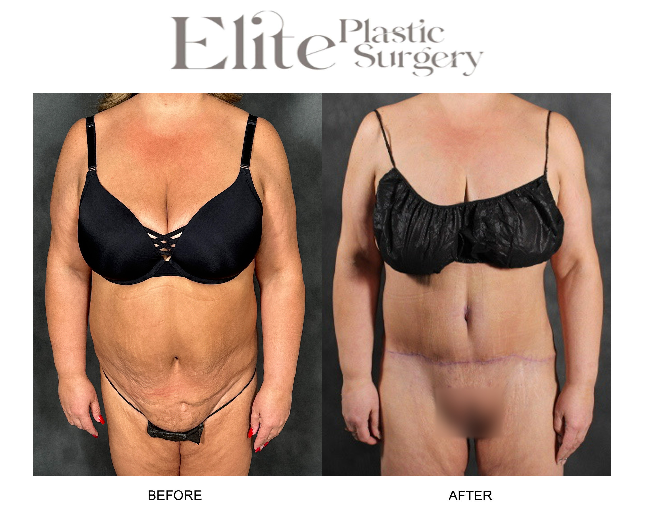Liposuction Before & After Gallery - Patient 278980 - Image 1