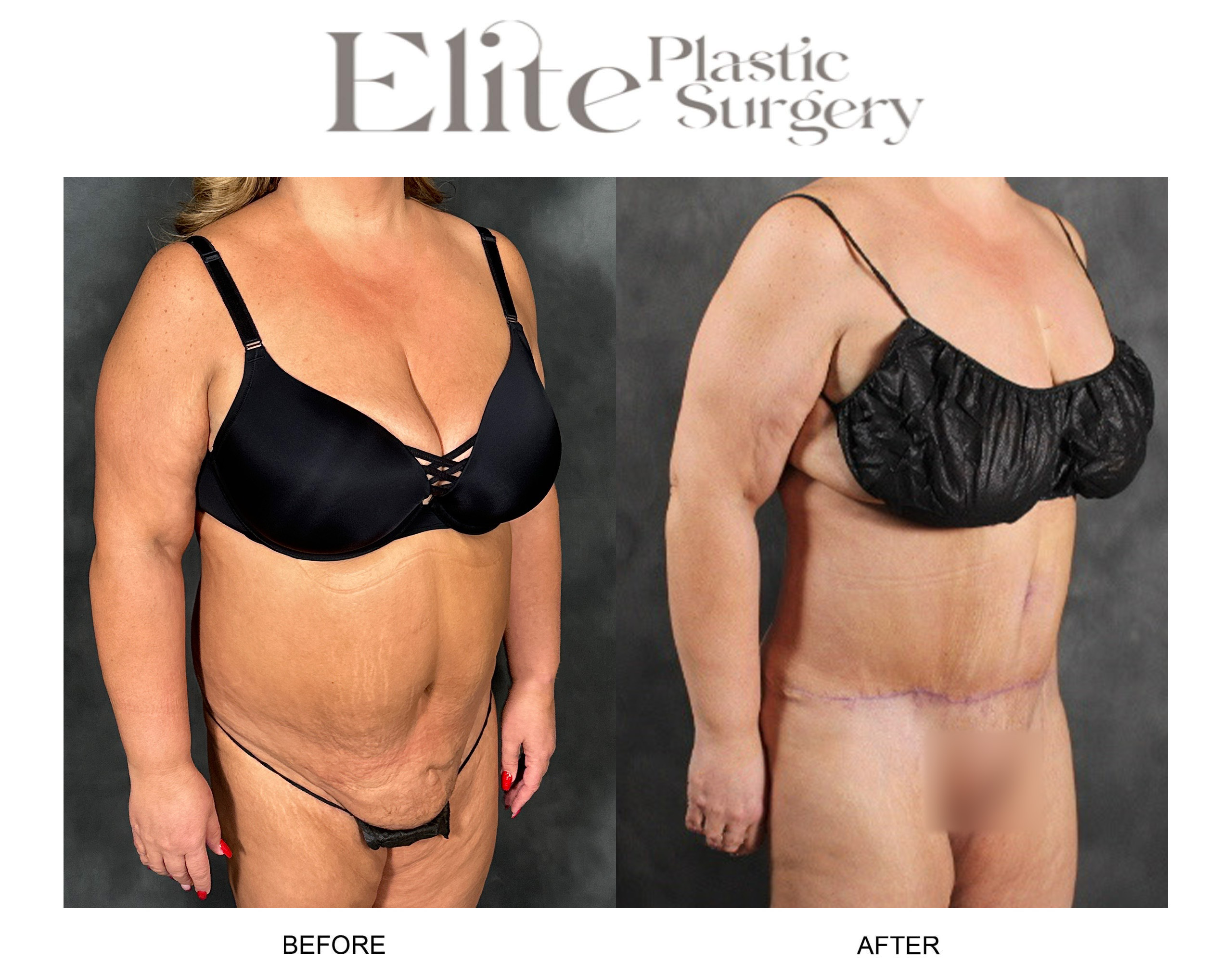 Liposuction Before & After Gallery - Patient 278980 - Image 2