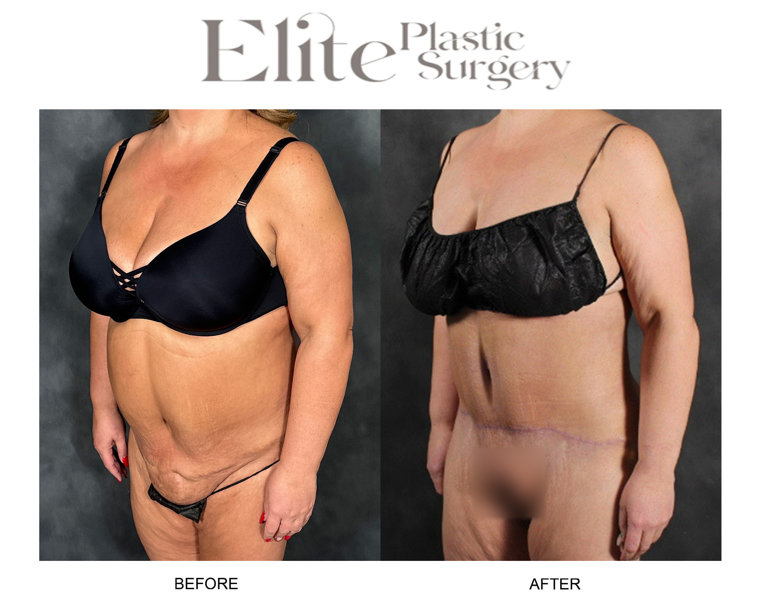 Liposuction Before & After Gallery - Patient 278980 - Image 3