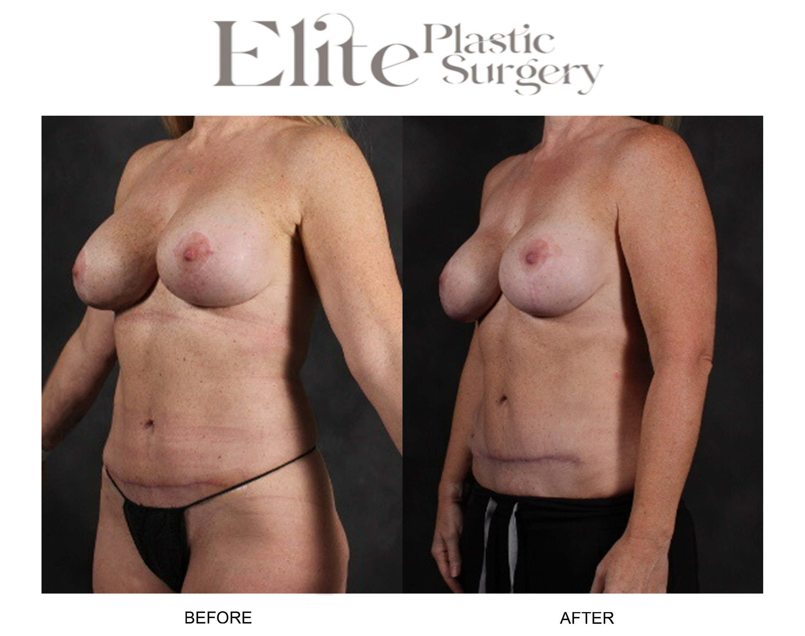 Liposuction Before & After Gallery - Patient 245928 - Image 3