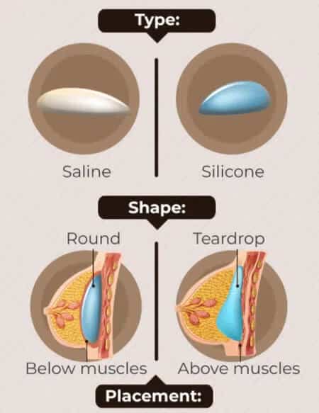 Techniques Implants