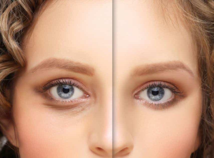 What You Need to Know About Blepharoplasty