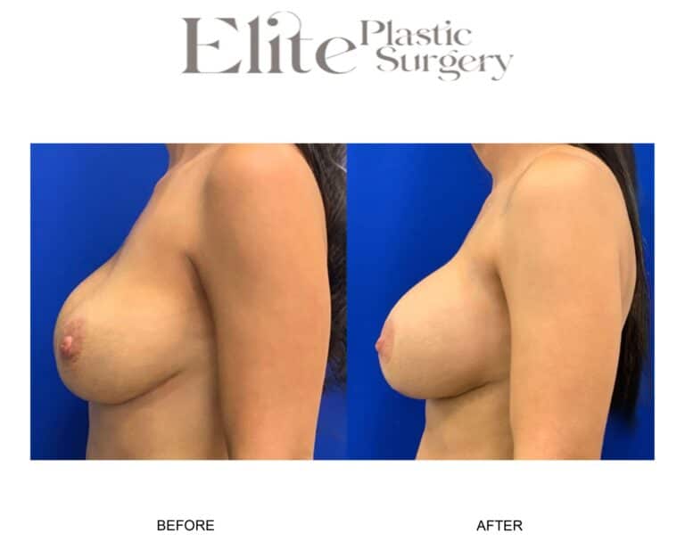 Patient 114983 Breast Lift 01 - Elite Plastic Surgery