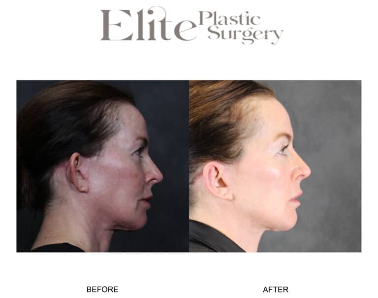 Patient 126861-otoplasty-01