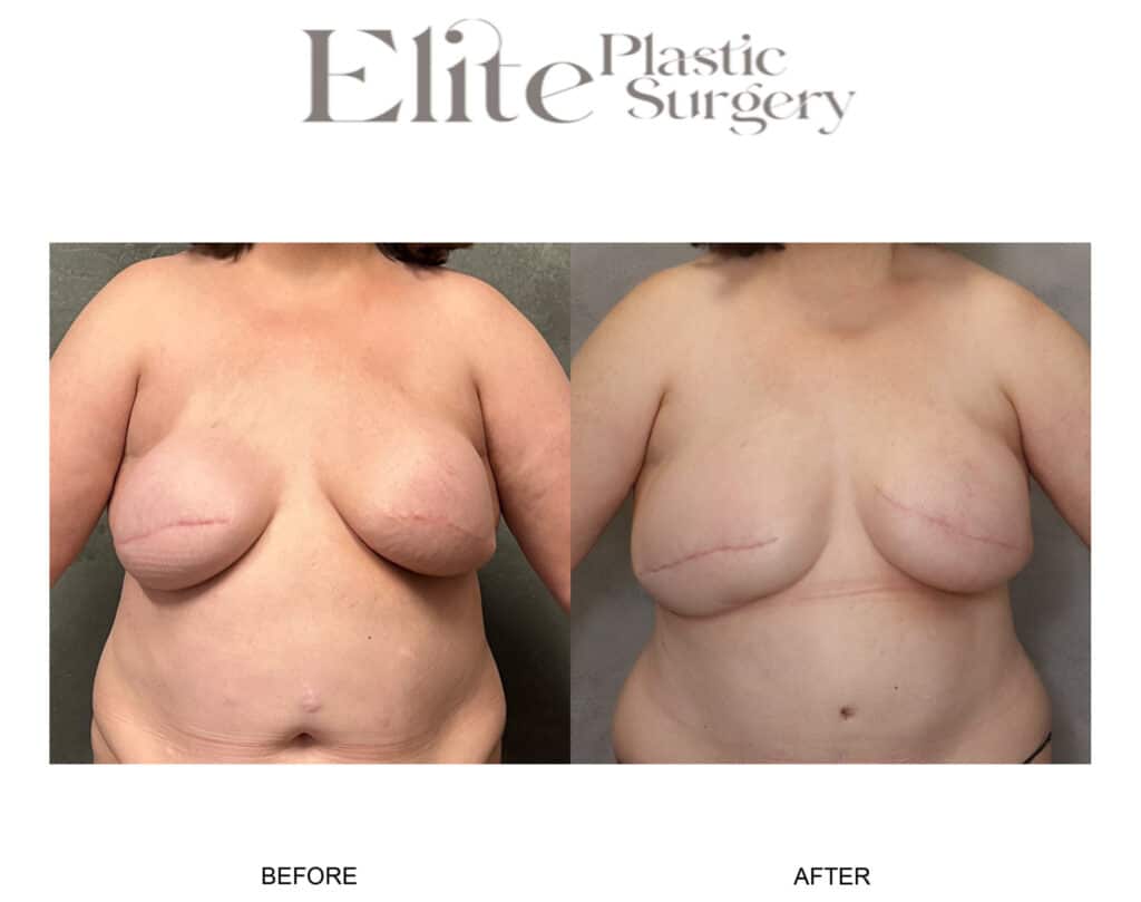 Patient 266472 DEIP BreastReconstruction 01 - Elite Plastic Surgery