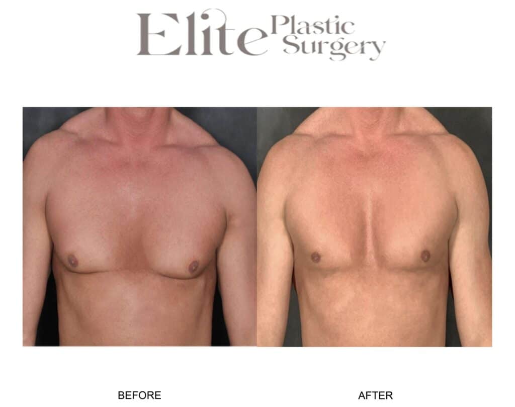 Patient 382441 male gynecomastia 01 - Elite Plastic Surgery