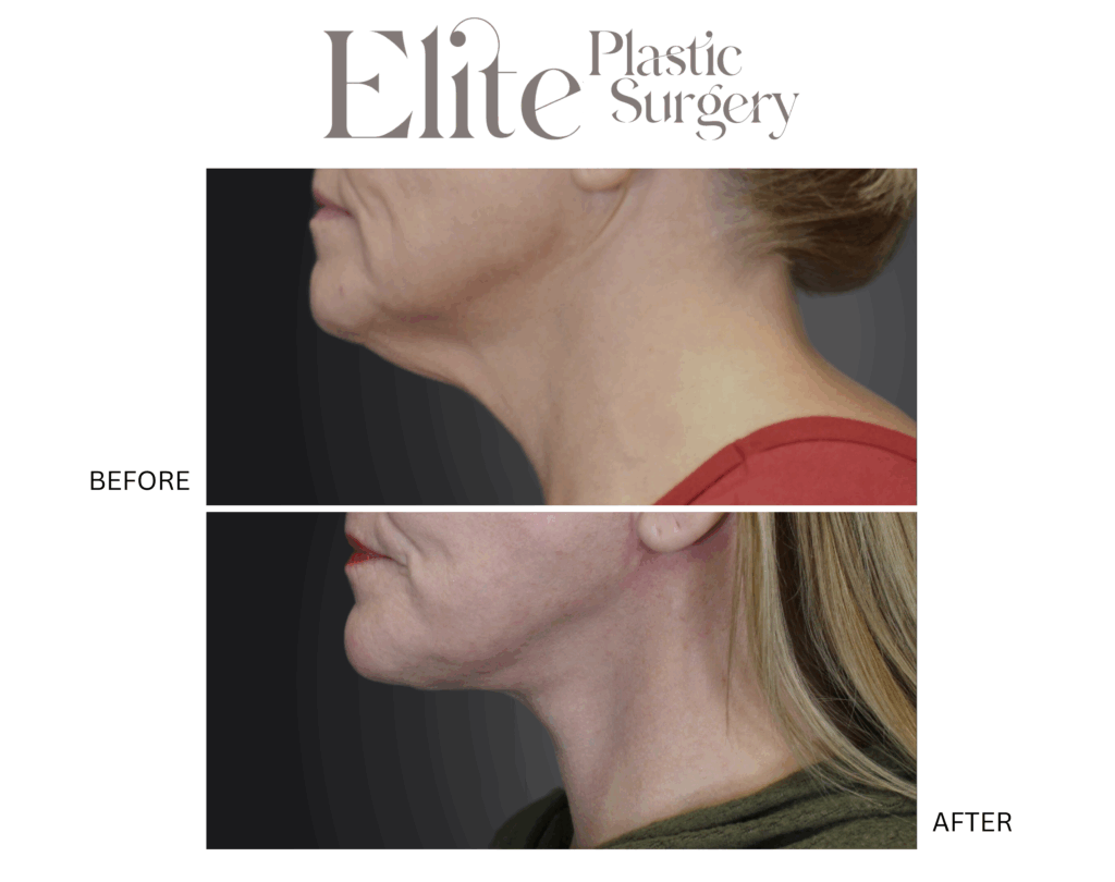 Patient 413426 Neck Lift