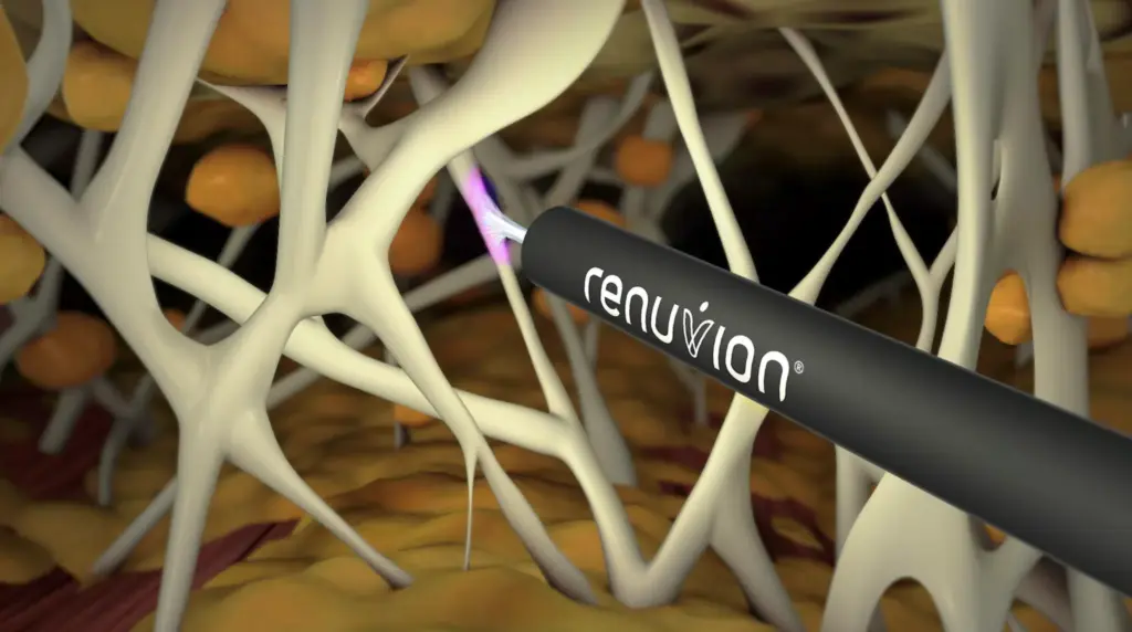 Renuvion in Phoenix & Chandler, AZ
