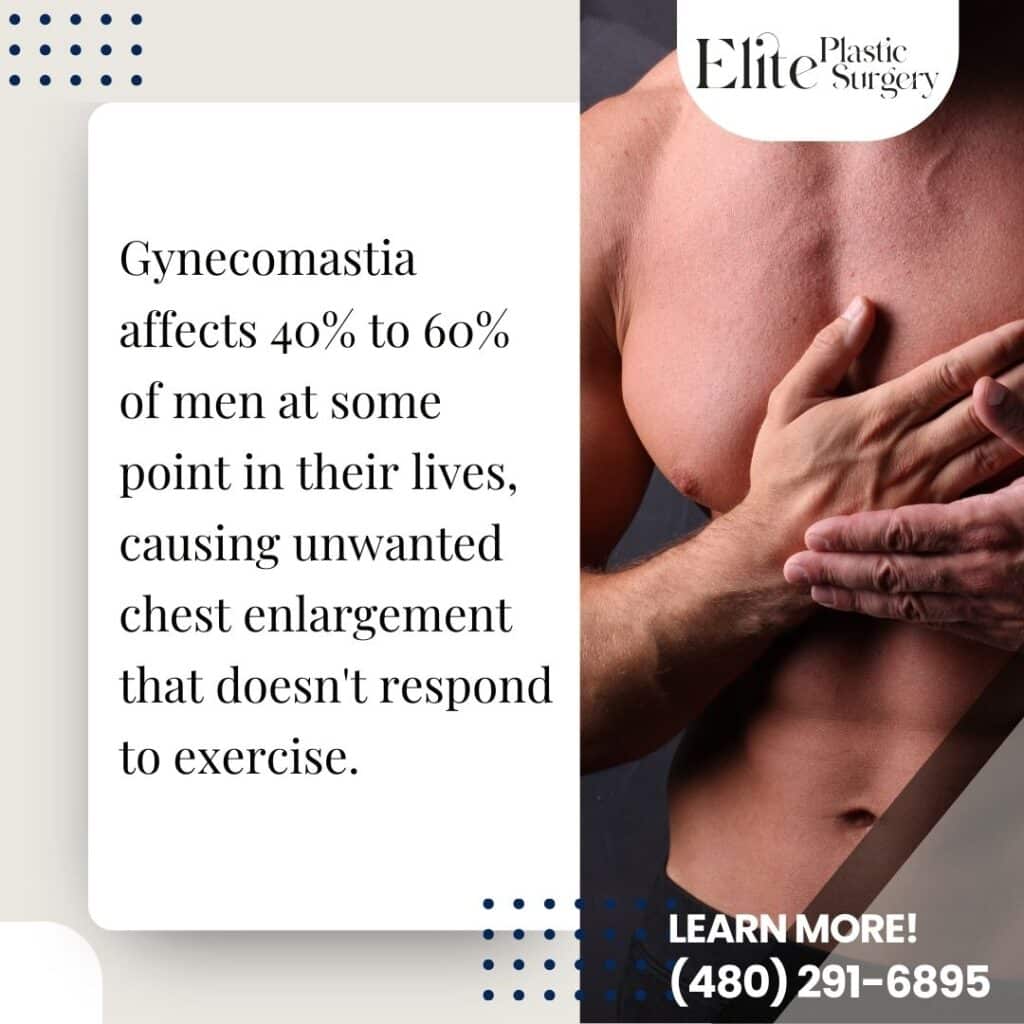 gynecomastia treatment