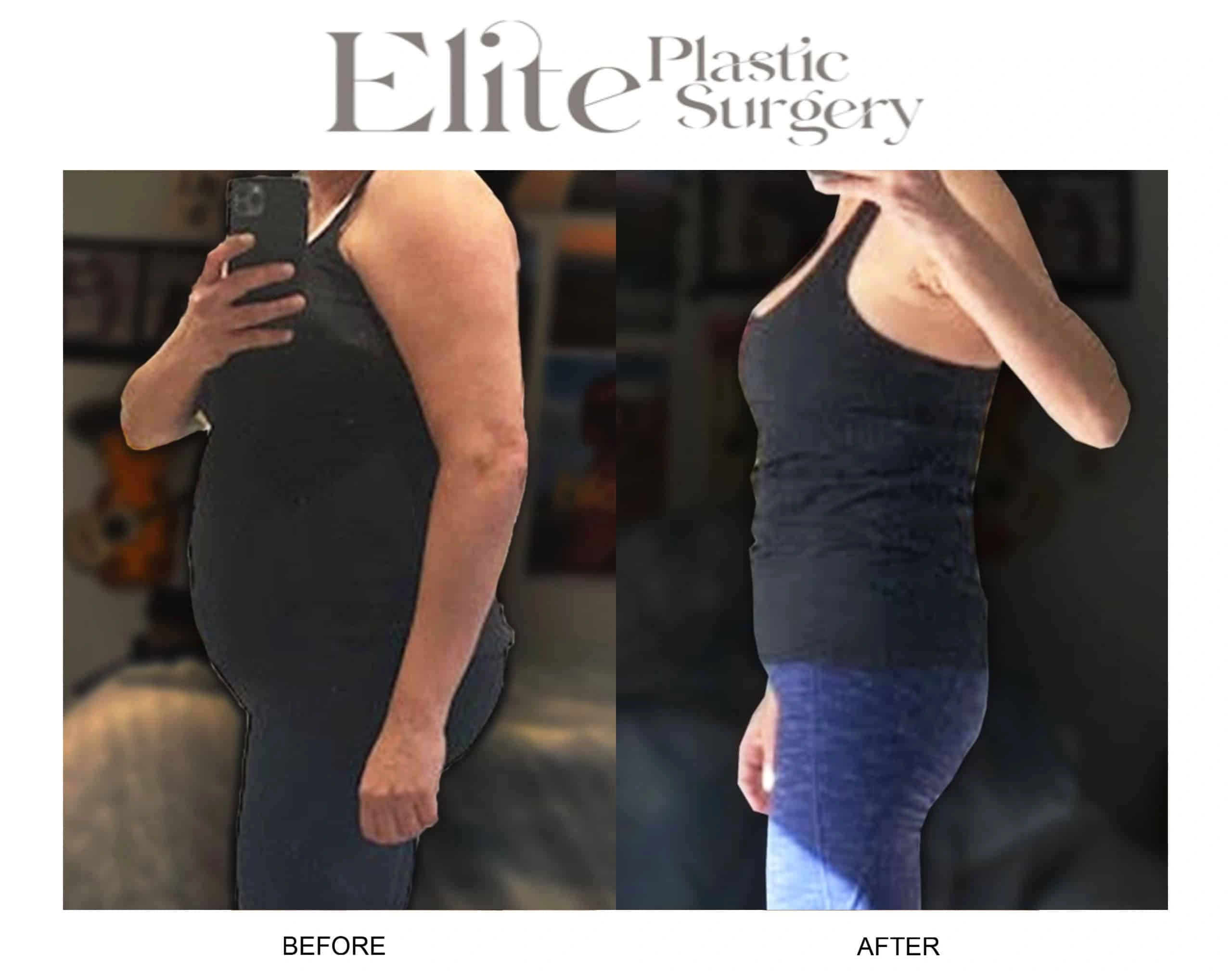 Real patient results before and after plastic surgery results in Arizona, performed by Dr. Torabi