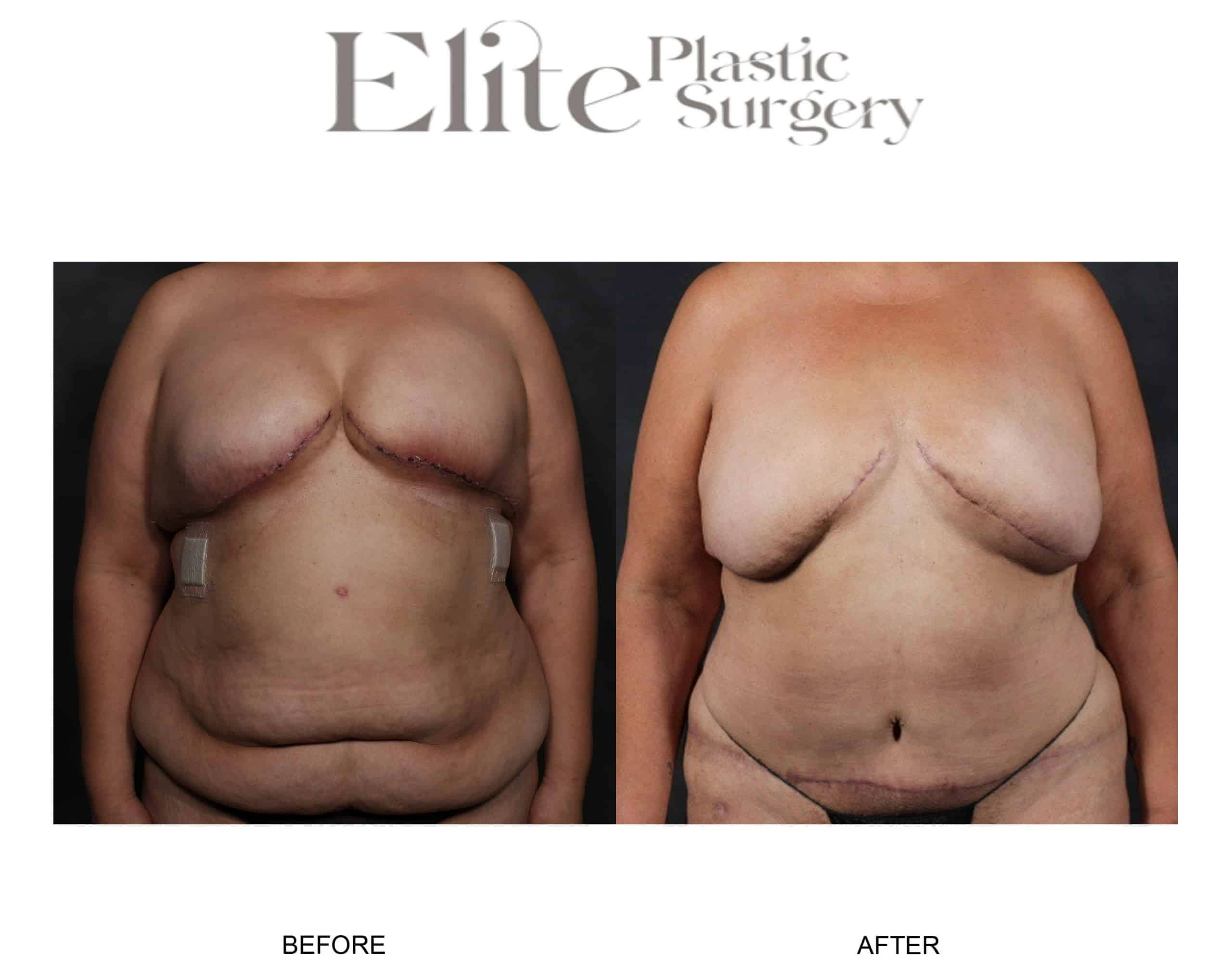 Real patient results before and after plastic surgery results in Arizona, performed by Dr. Torabi