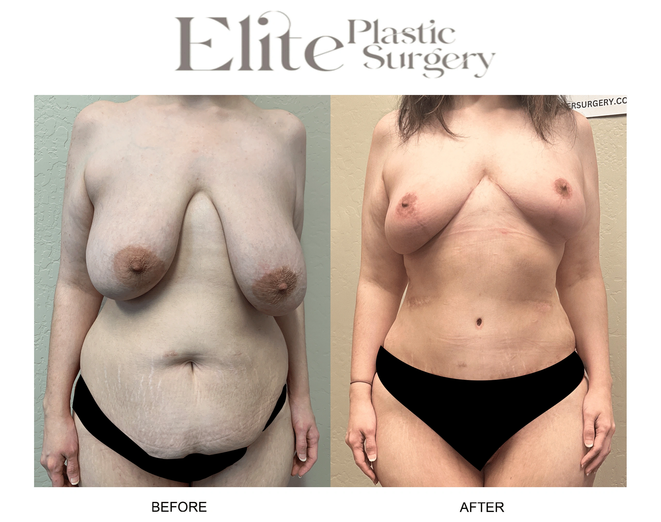 Real patient results before and after plastic surgery results in Arizona, performed by Dr. Torabi