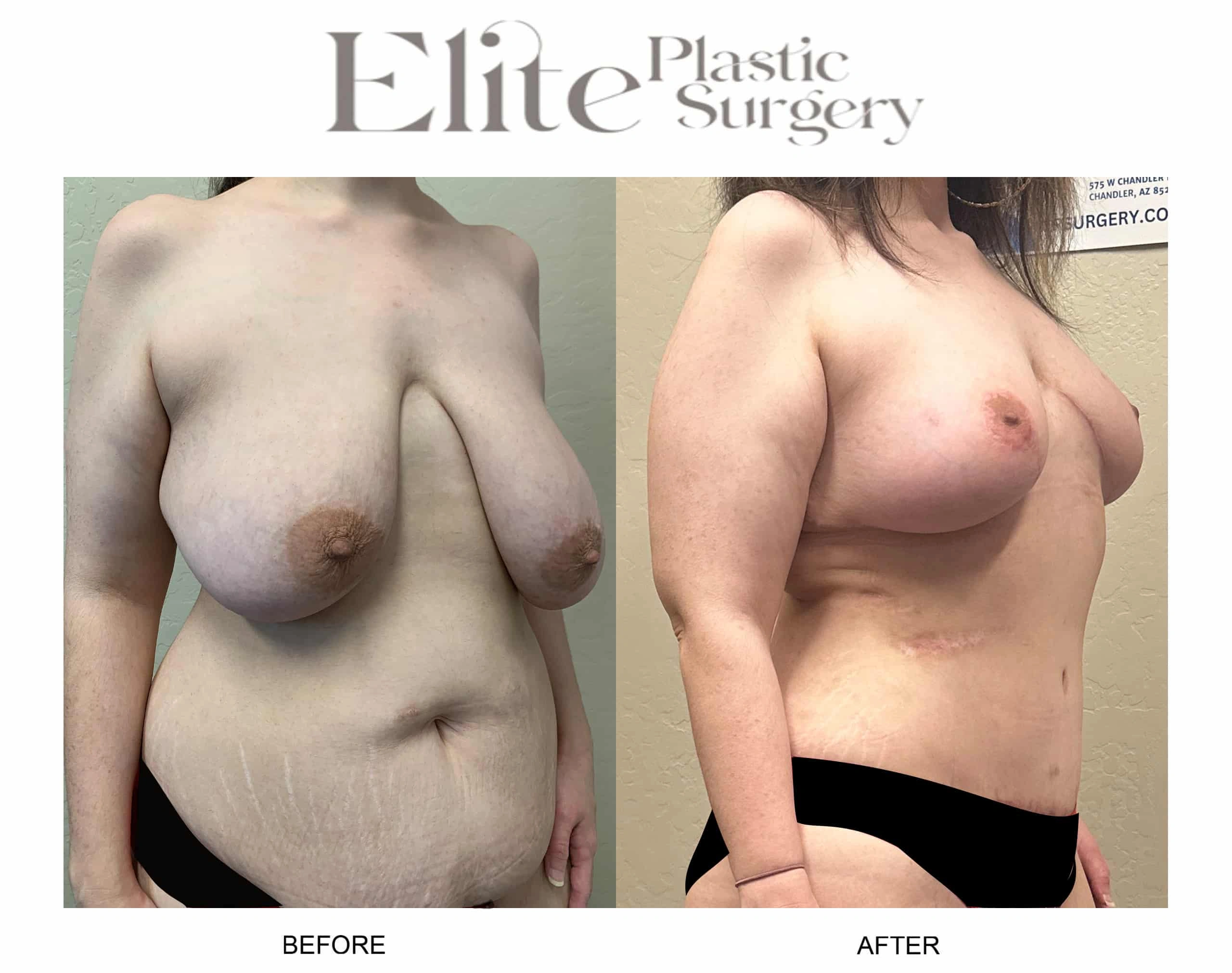 Real patient results before and after plastic surgery results in Arizona, performed by Dr. Torabi