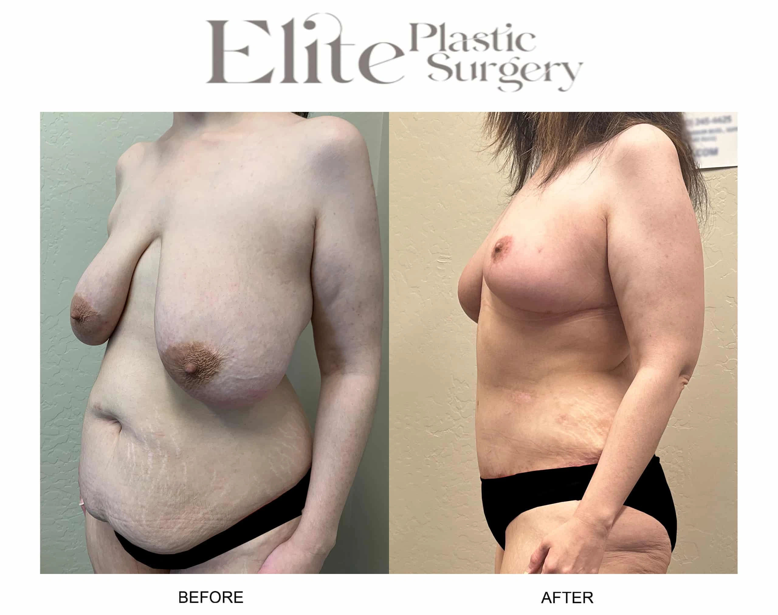 Real patient results before and after plastic surgery results in Arizona, performed by Dr. Torabi