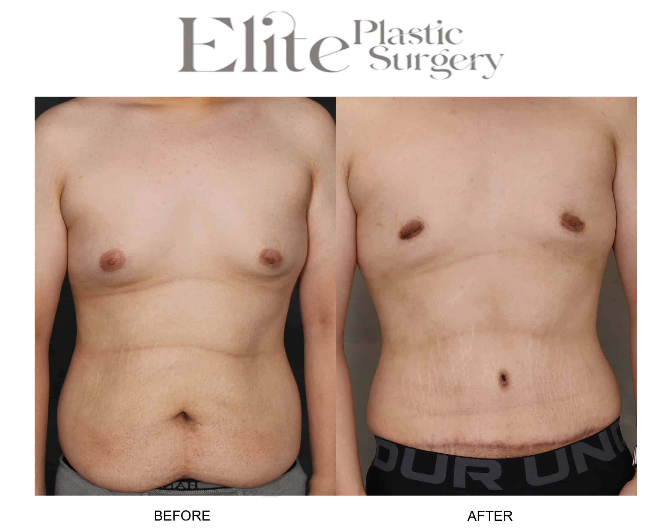 Real patient results before and after plastic surgery results in Arizona, performed by Dr. Torabi