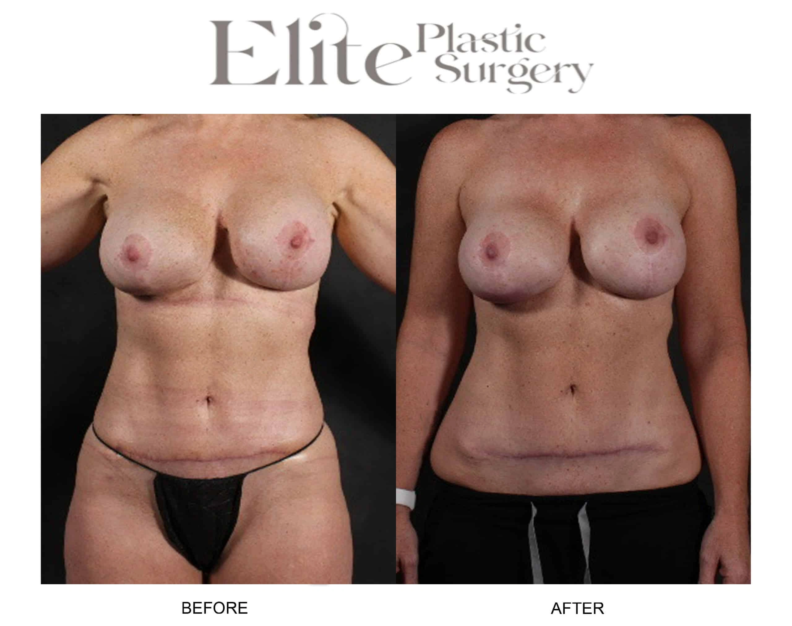 Real patient results before and after plastic surgery results in Arizona, performed by Dr. Torabi