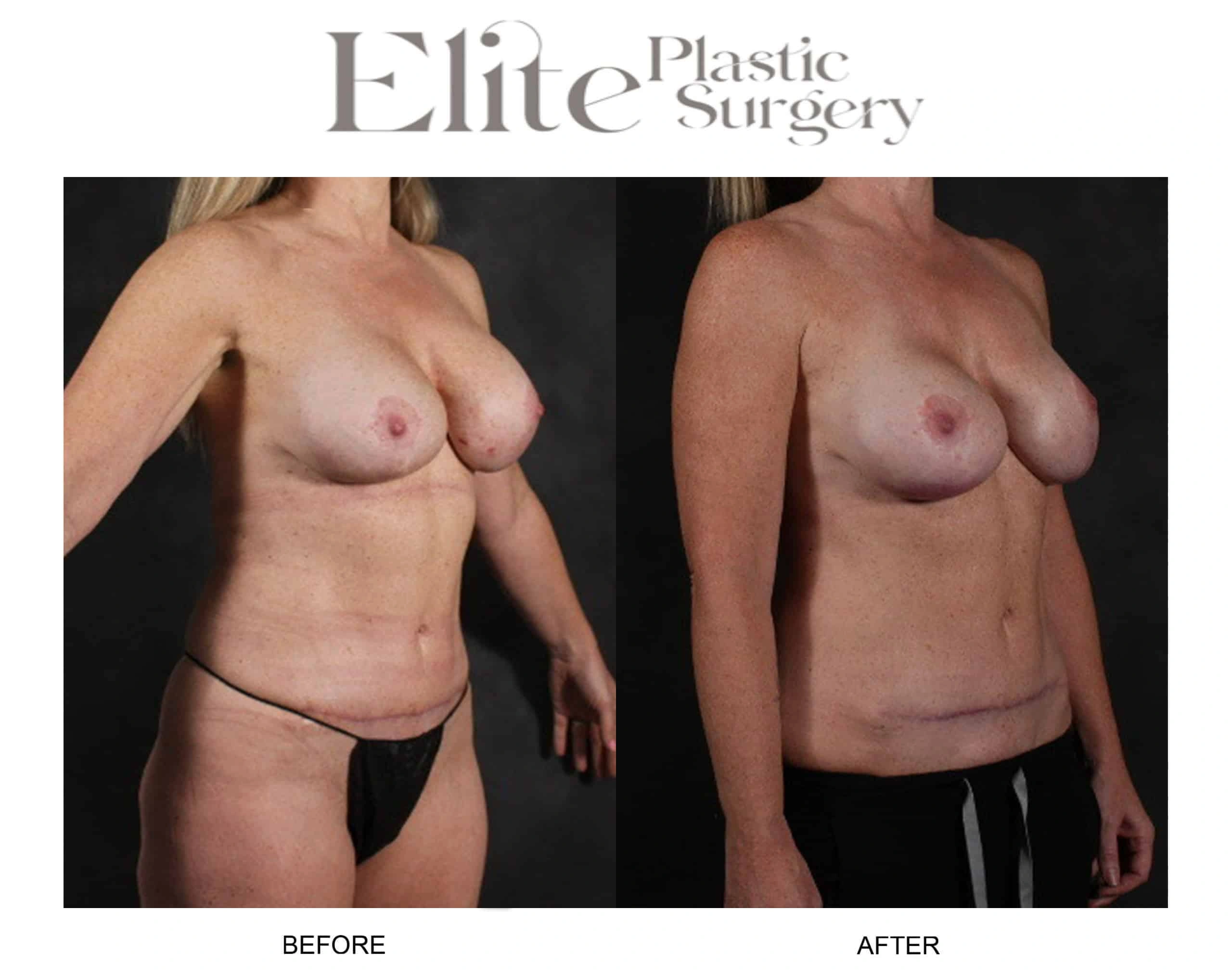 Real patient results before and after plastic surgery results in Arizona, performed by Dr. Torabi