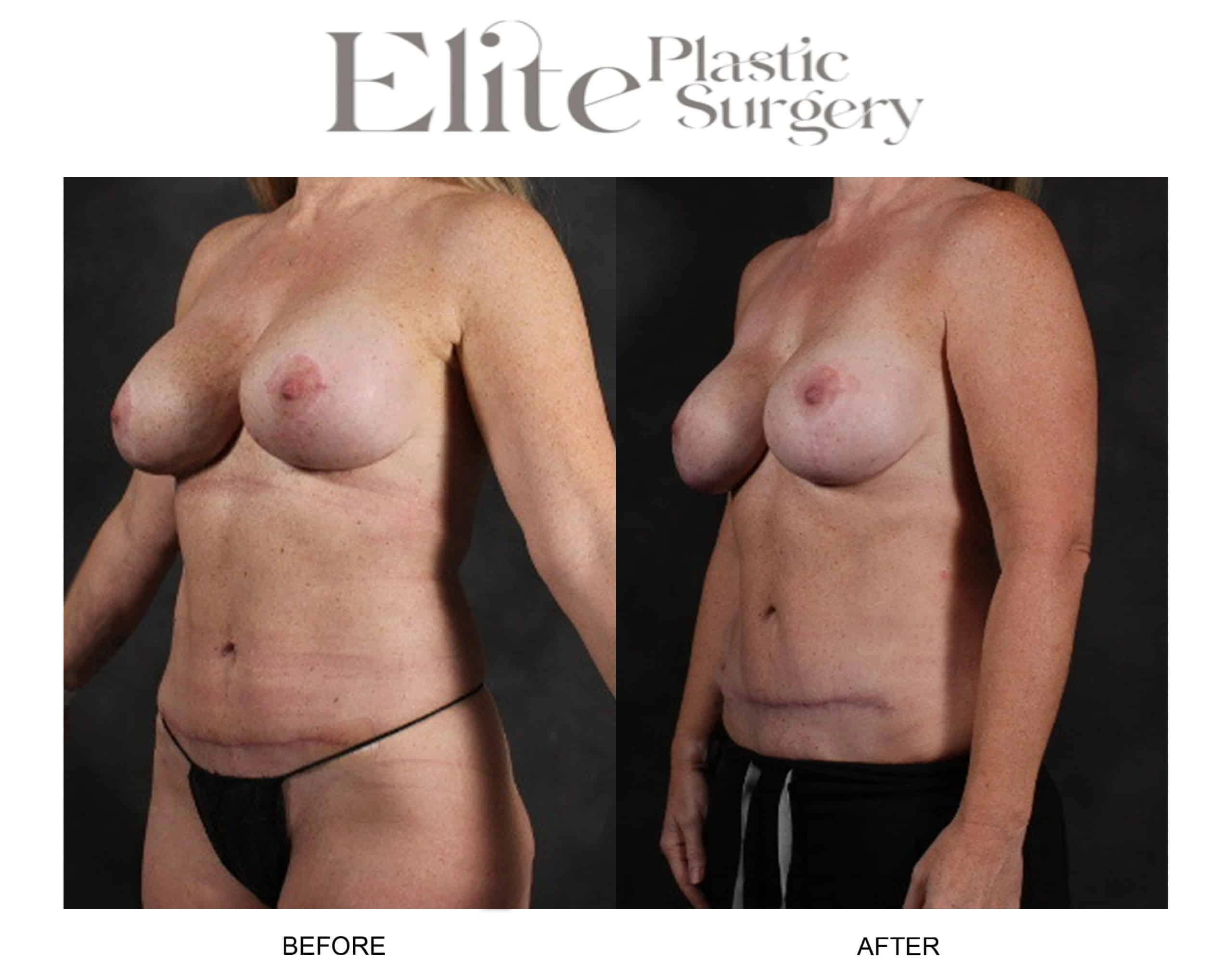 Real patient results before and after plastic surgery results in Arizona, performed by Dr. Torabi