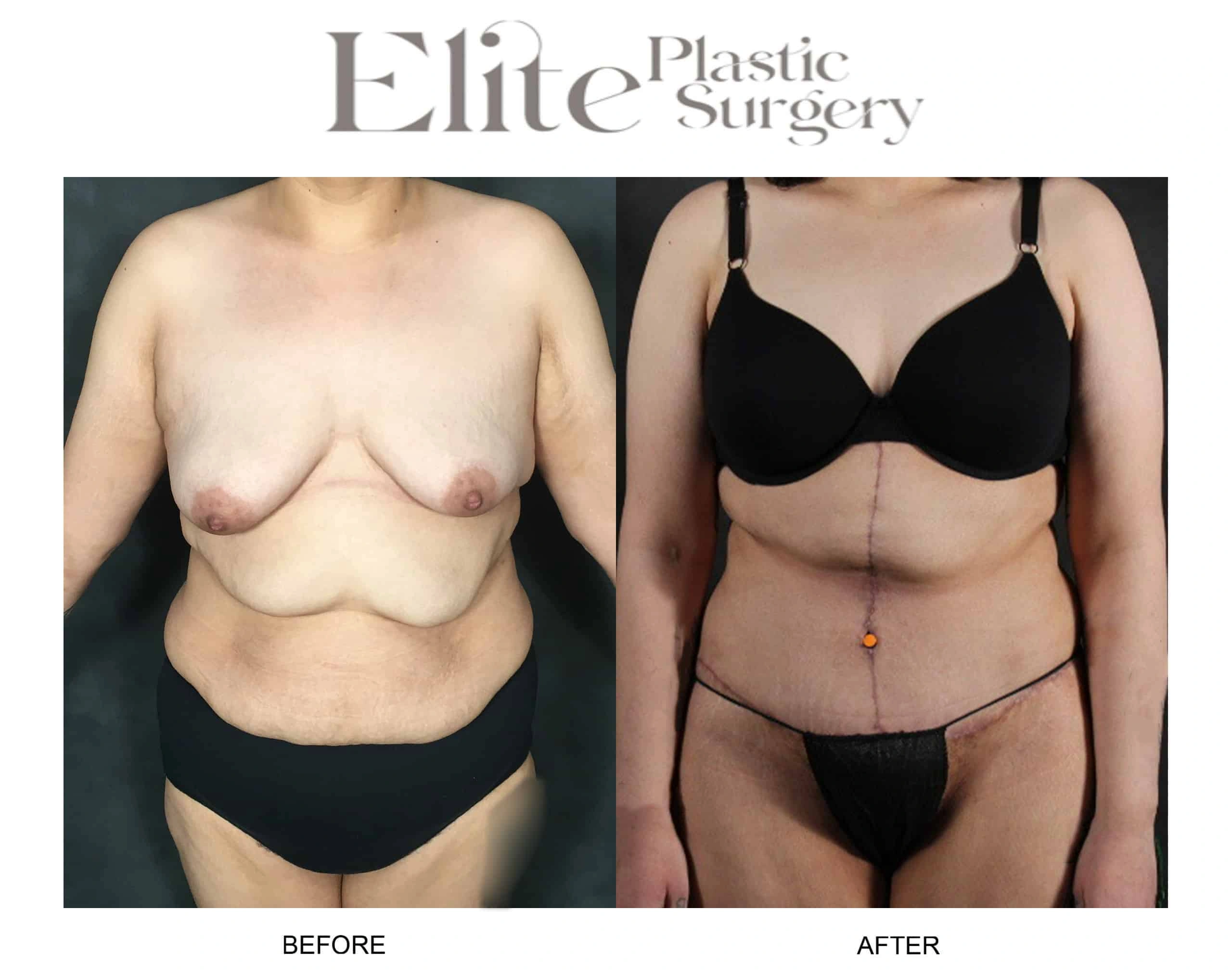 Real patient results before and after plastic surgery results in Arizona, performed by Dr. Torabi