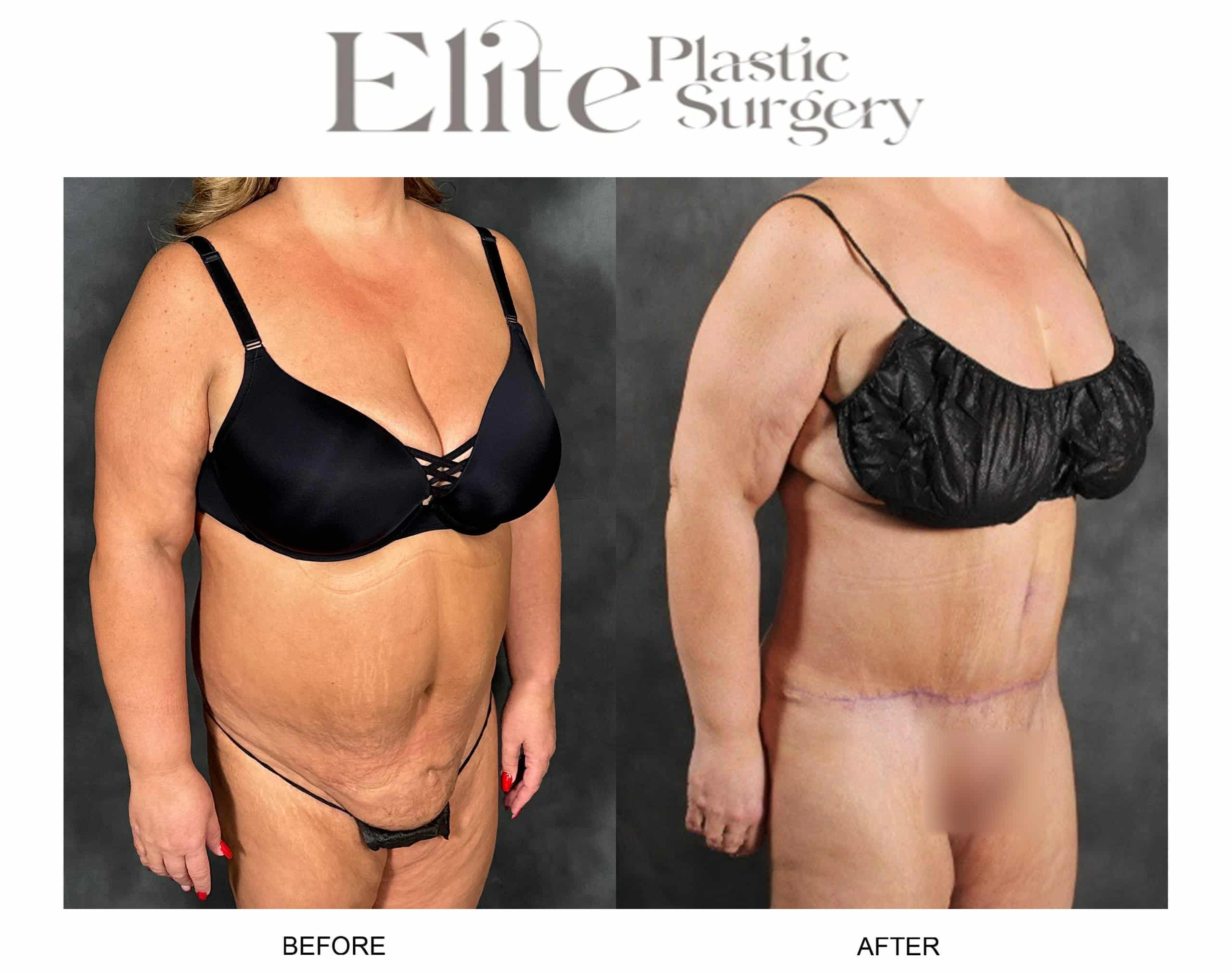 Real patient results before and after plastic surgery results in Arizona, performed by Dr. Torabi