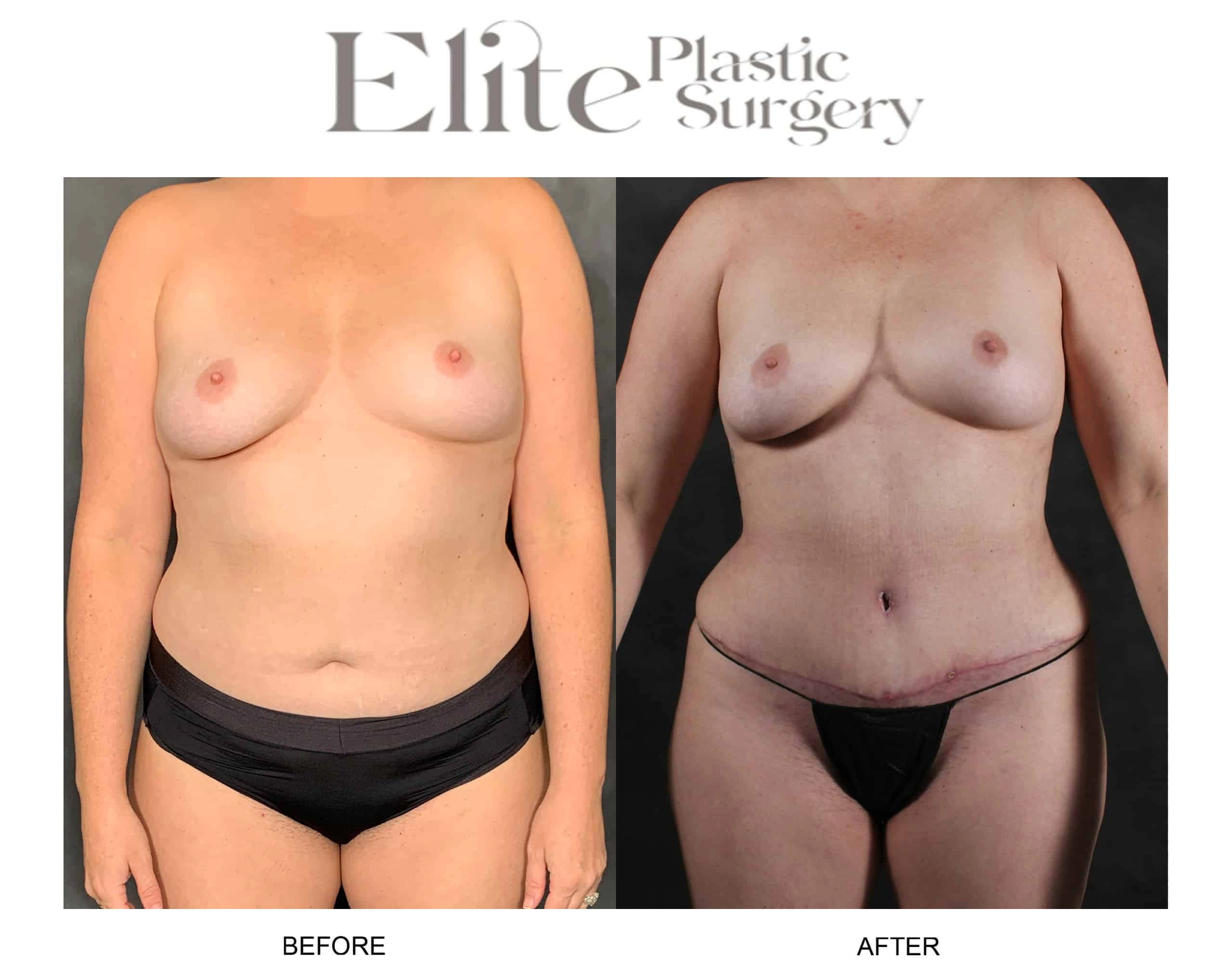 Real patient results before and after plastic surgery results in Arizona, performed by Dr. Torabi