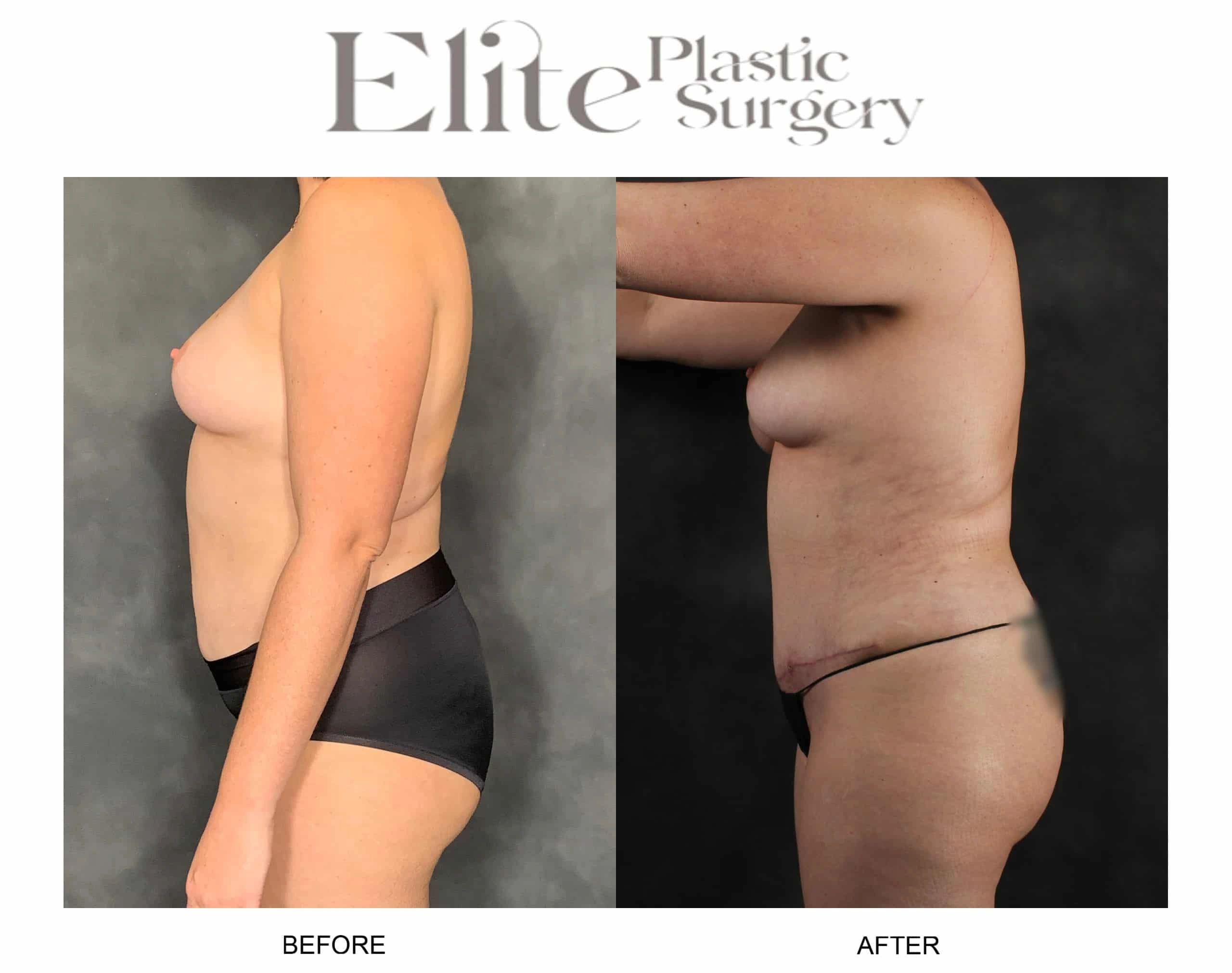 Real patient results before and after plastic surgery results in Arizona, performed by Dr. Torabi