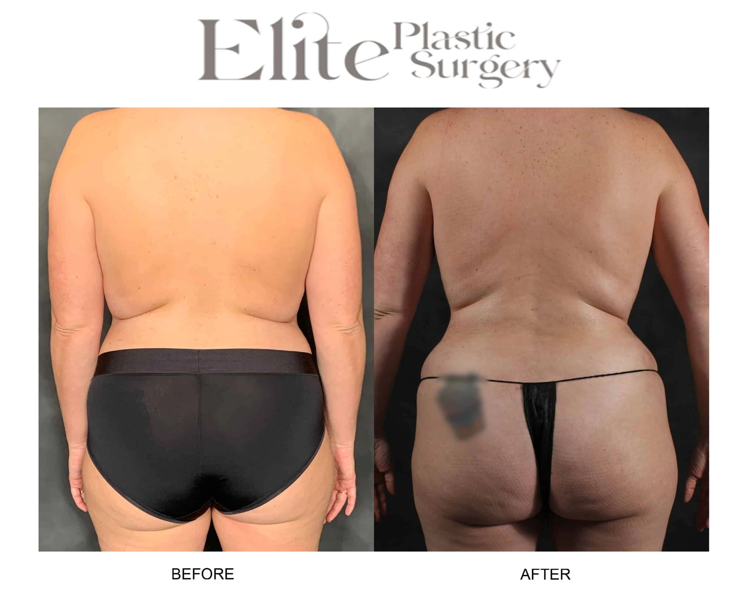 Real patient results before and after plastic surgery results in Arizona, performed by Dr. Torabi