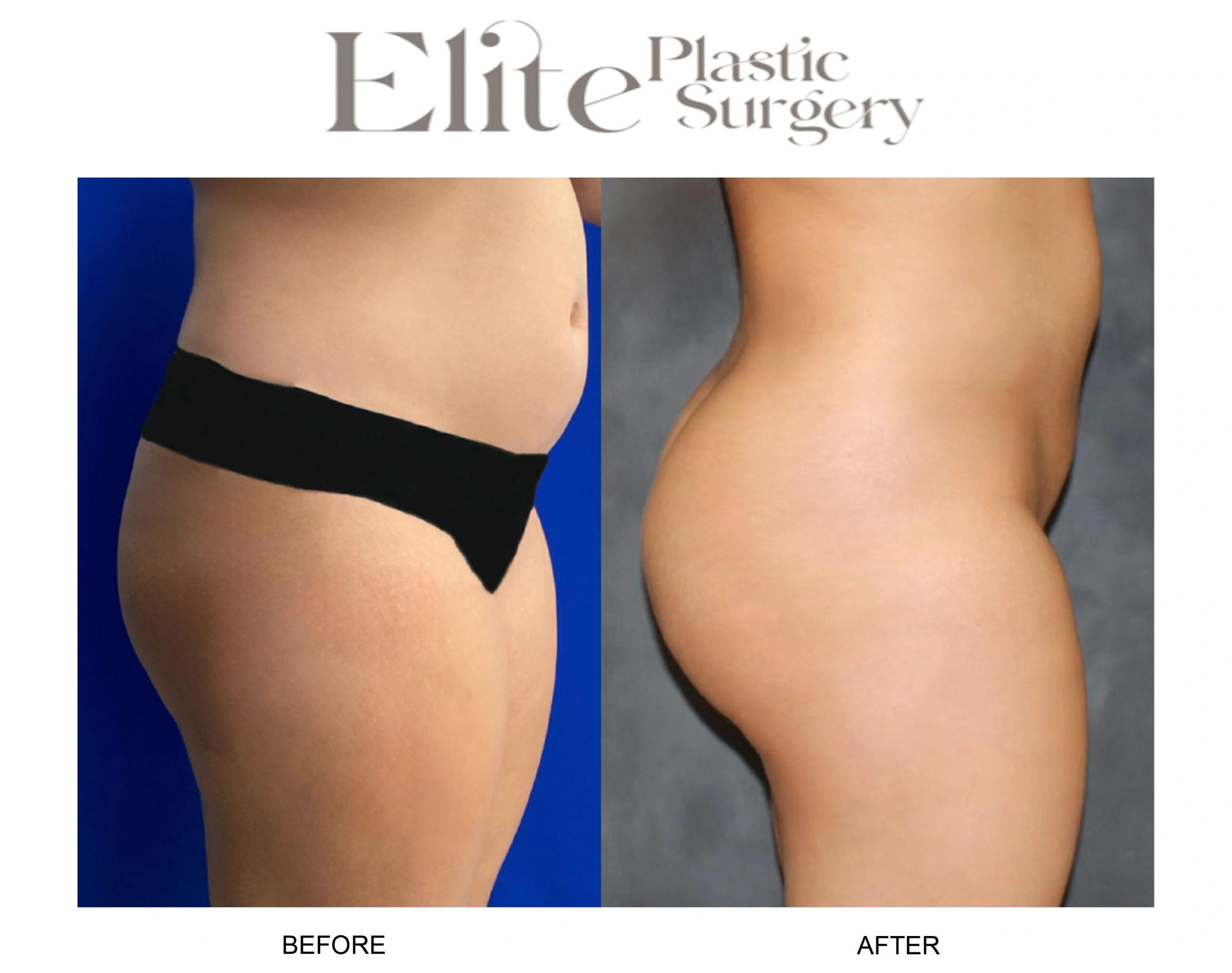 Real patient results before and after plastic surgery results in Arizona, performed by Dr. Torabi