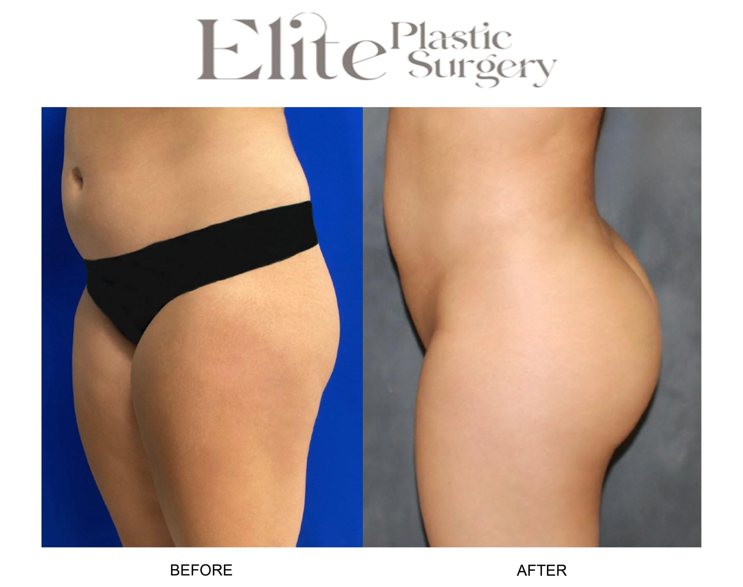 Real patient results before and after plastic surgery results in Arizona, performed by Dr. Torabi