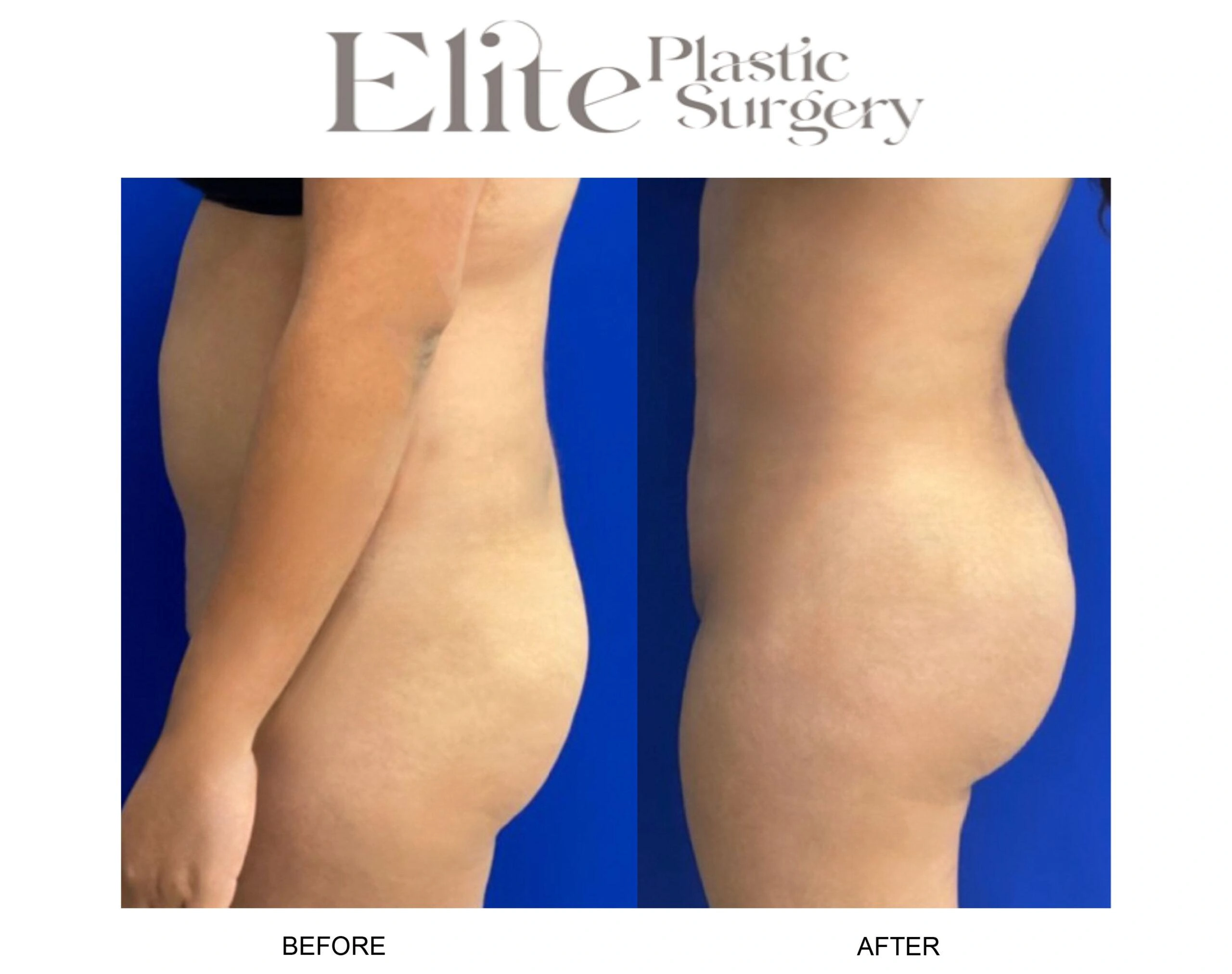 Real patient results before and after plastic surgery results in Arizona, performed by Dr. Torabi