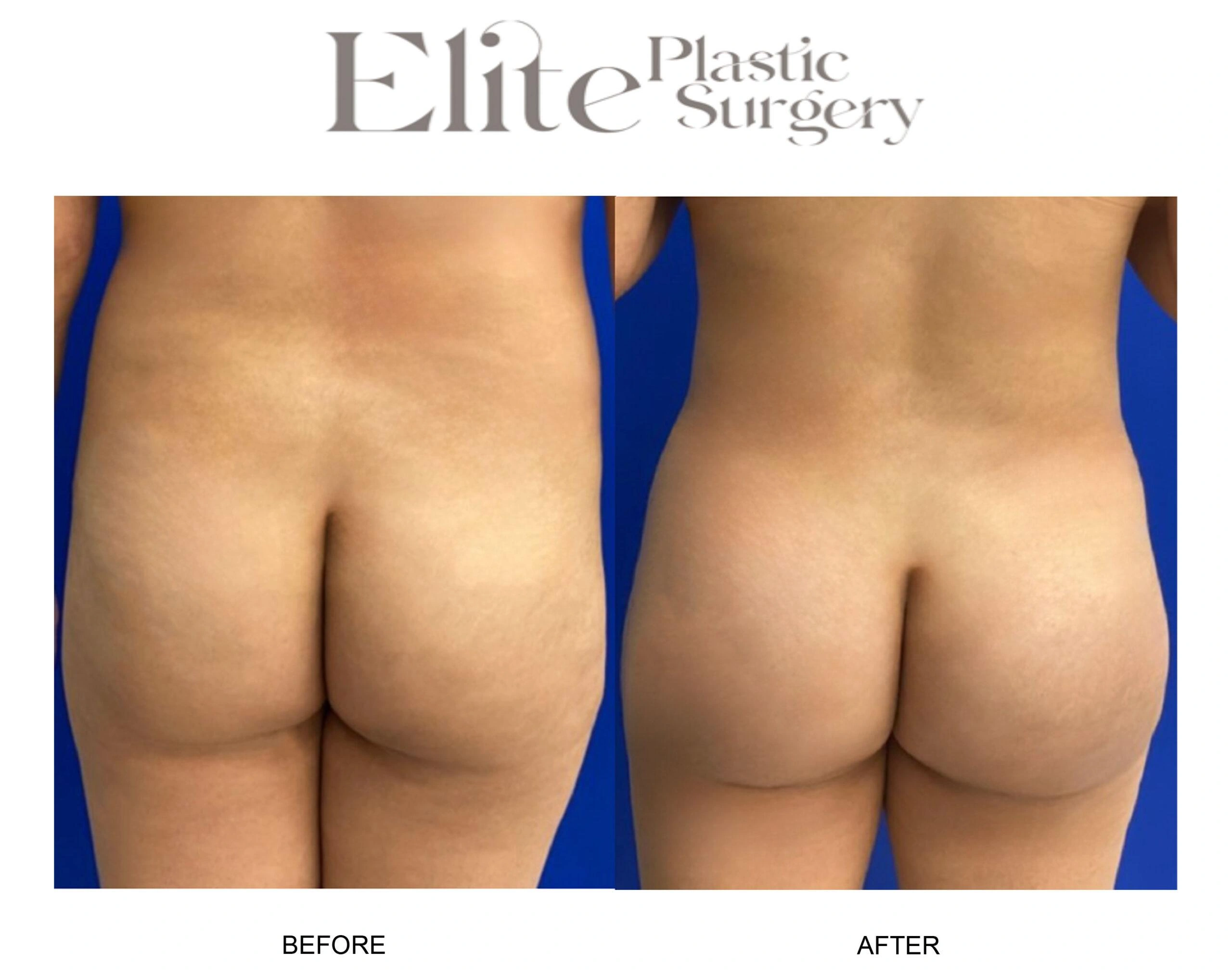 Real patient results before and after plastic surgery results in Arizona, performed by Dr. Torabi