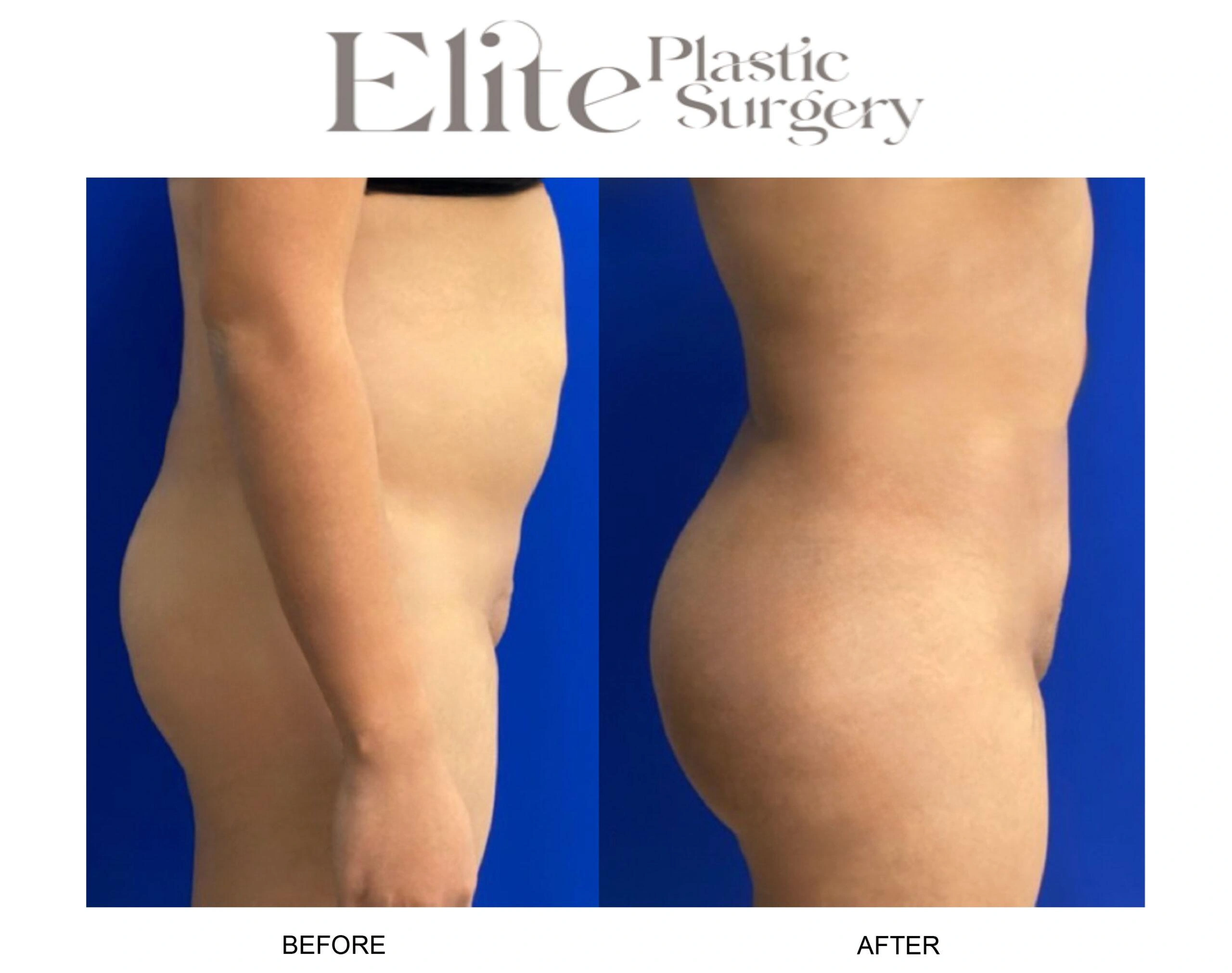 Real patient results before and after plastic surgery results in Arizona, performed by Dr. Torabi