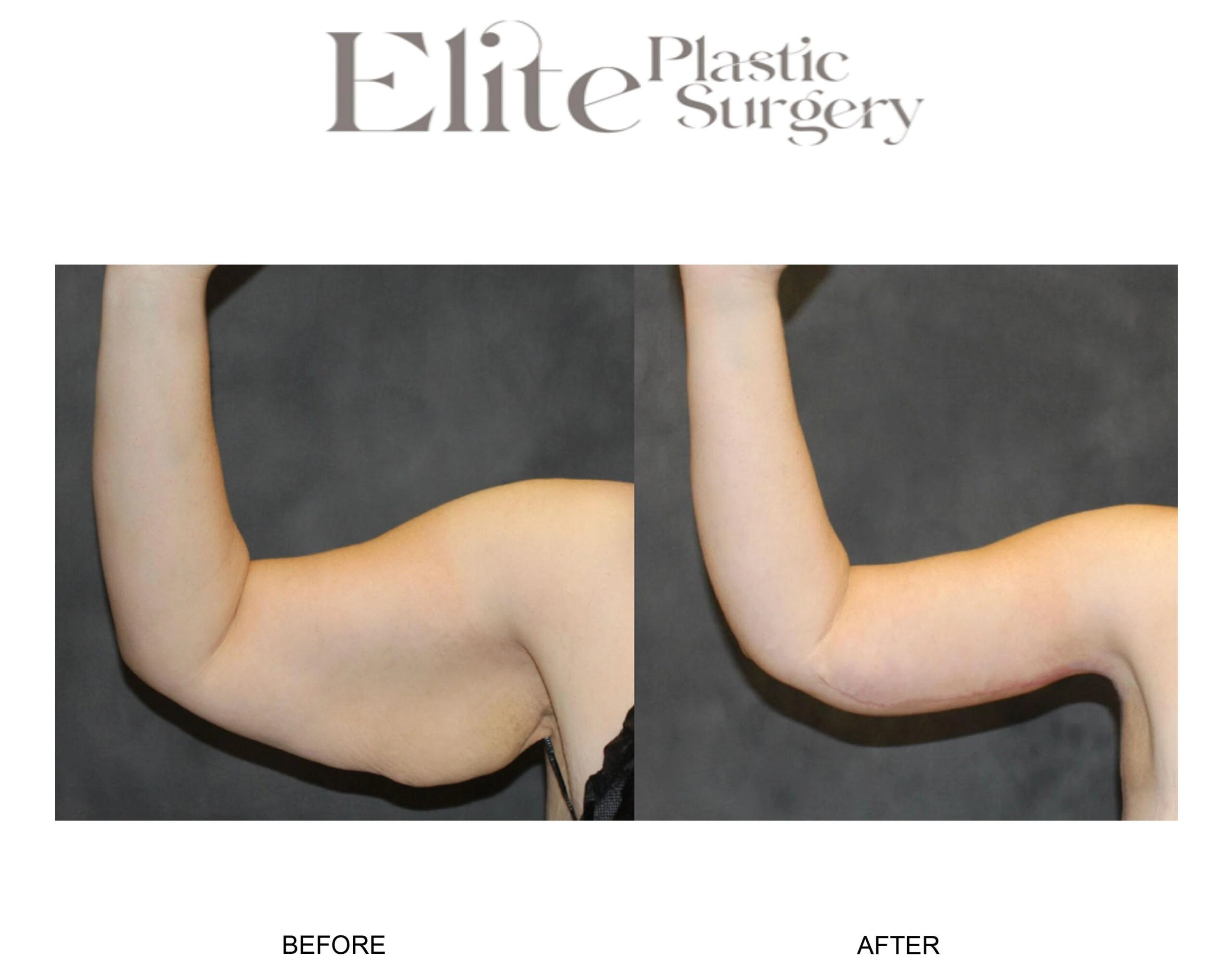 Real patient results before and after plastic surgery results in Arizona, performed by Dr. Torabi