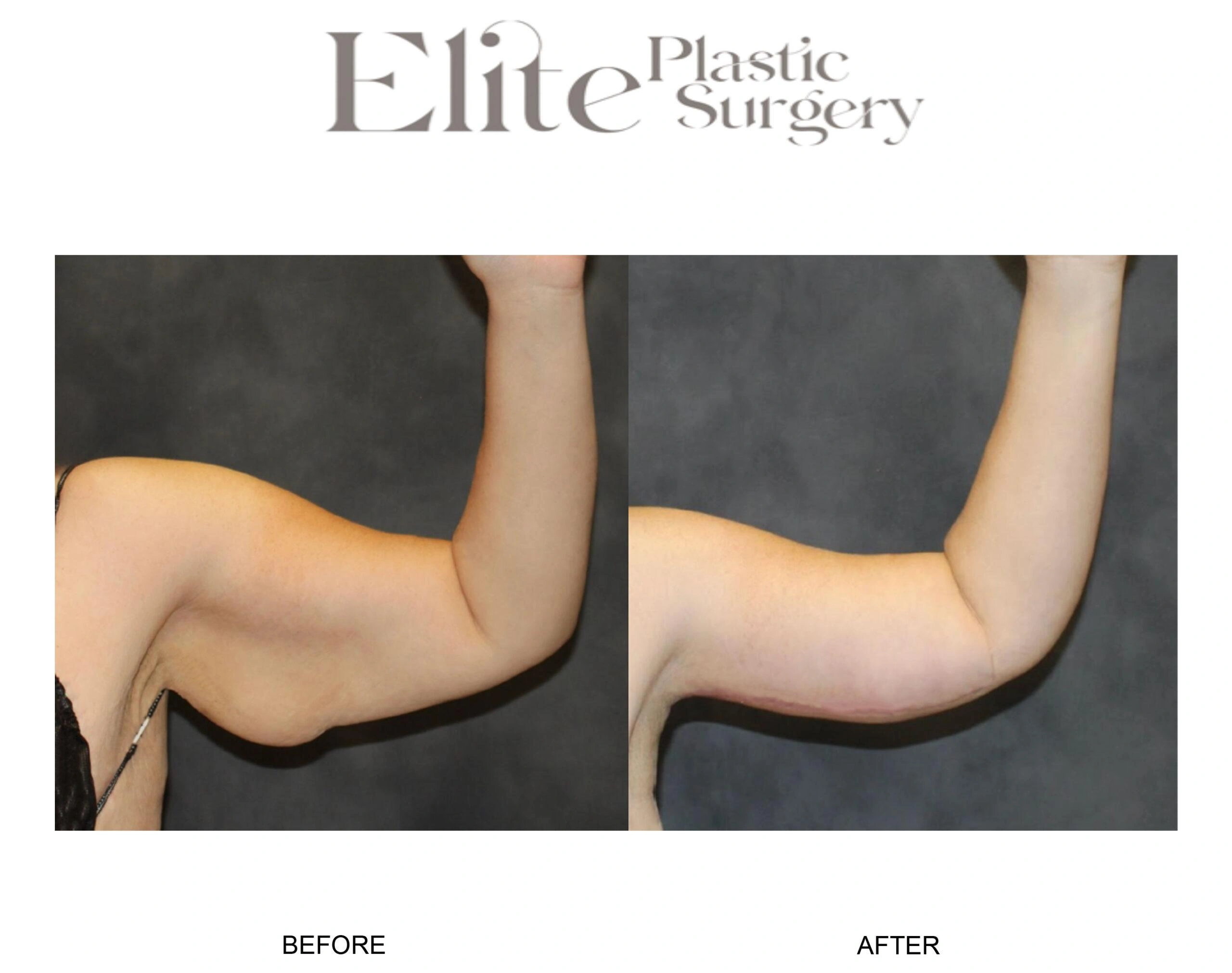 Real patient results before and after plastic surgery results in Arizona, performed by Dr. Torabi