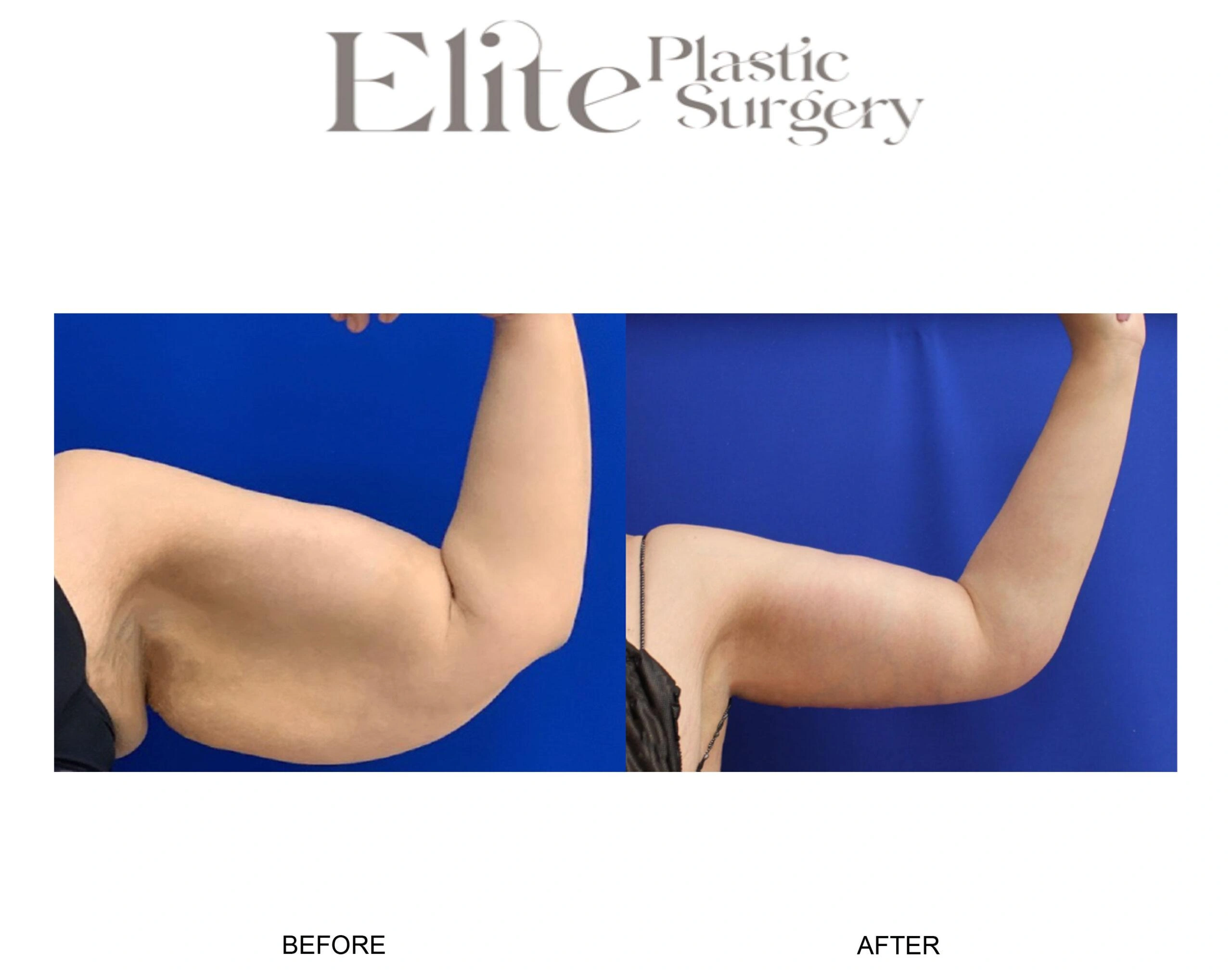 Real patient results before and after plastic surgery results in Arizona, performed by Dr. Torabi