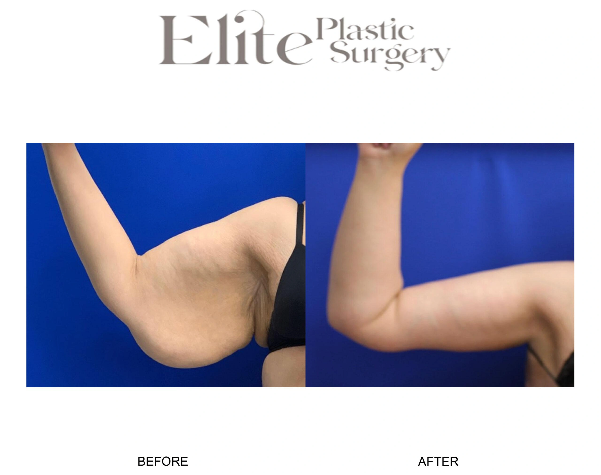 Real patient results before and after plastic surgery results in Arizona, performed by Dr. Torabi