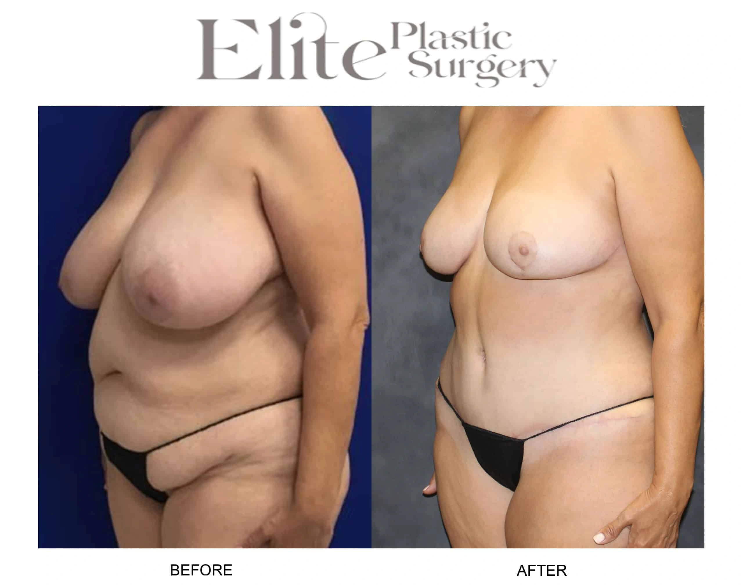 Real patient results before and after plastic surgery results in Arizona, performed by Dr. Torabi