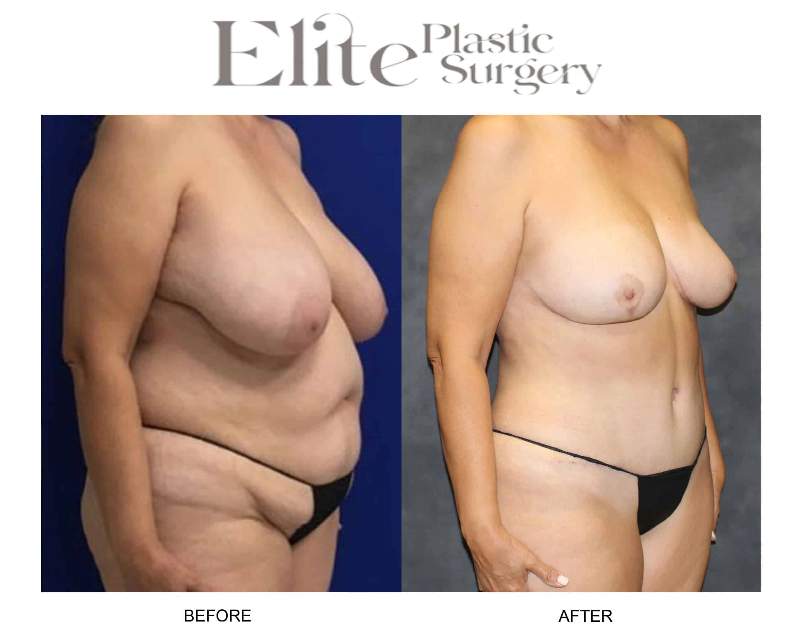 Real patient results before and after plastic surgery results in Arizona, performed by Dr. Torabi
